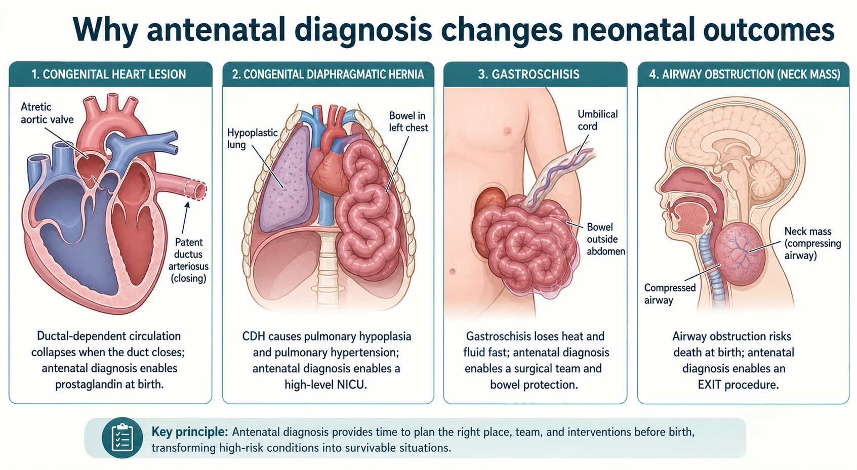 Educational mechanism diagram with four panels showing ductal-dependent duct closure, congenital diaphragmatic hernia pulmonary hypoplasia, gastroschisis heat and fluid loss, and airway obstruction with EXIT rationale