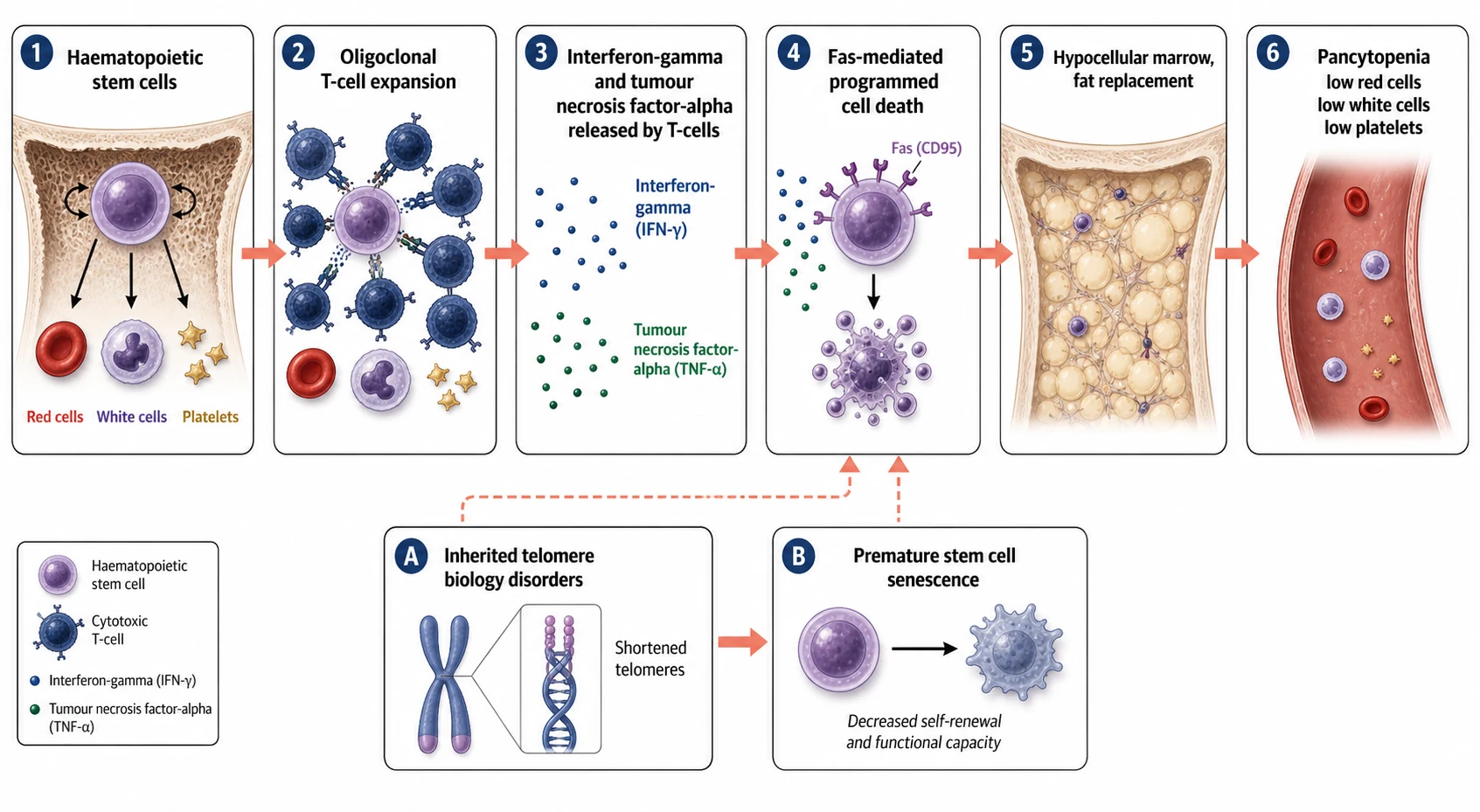 A clean scientific causal schematic on a white background. Six connected boxes flow left to right joined by coral arrows. Box one shows haematopoietic stem cells with red cells, white cells, and platelets. Box two shows oligoclonal cytotoxic T cell expansion. Box three shows interferon-gamma and tumour necrosis factor-alpha released by the T cells. Box four shows Fas mediated programmed cell death. Box five shows hypocellular marrow with fat replacement. Box six shows pancytopenia with low red cells, low white cells, and low platelets. A secondary lower pathway shows inherited telomere biology disorders with shortened telomeres leading to premature stem cell senescence.