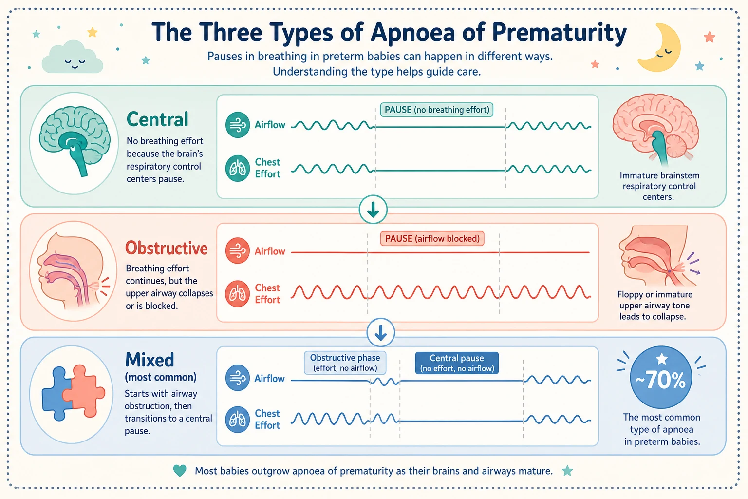 Classification of apnoea into central, obstructive and mixed types with periodic breathing comparison