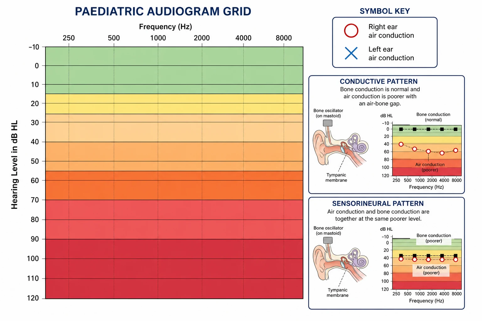 A labelled blank paediatric audiogram grid with frequency 250 to 8000 Hz on the x-axis and hearing level minus 10 to 120 dB HL on the y-axis, shaded into normal, slight, mild, moderate, moderately severe, severe and profound bands, with right and left air- and bone-conduction symbols, plus a conductive and a sensorineural pattern