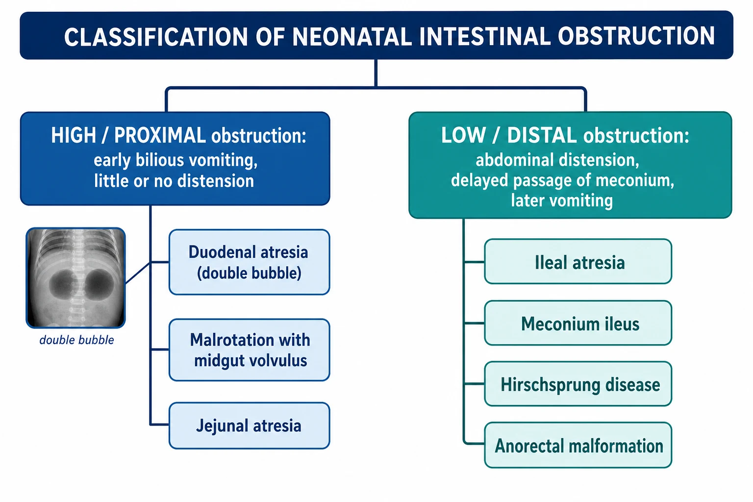 Classification chart of neonatal intestinal obstruction split into high proximal obstruction with early bilious vomiting and little distension, listing duodenal atresia with double bubble, malrotation with midgut volvulus and jejunal atresia, versus low distal obstruction with distension and delayed passage of meconium, listing ileal atresia, meconium ileus, Hirschsprung disease and anorectal malformation.