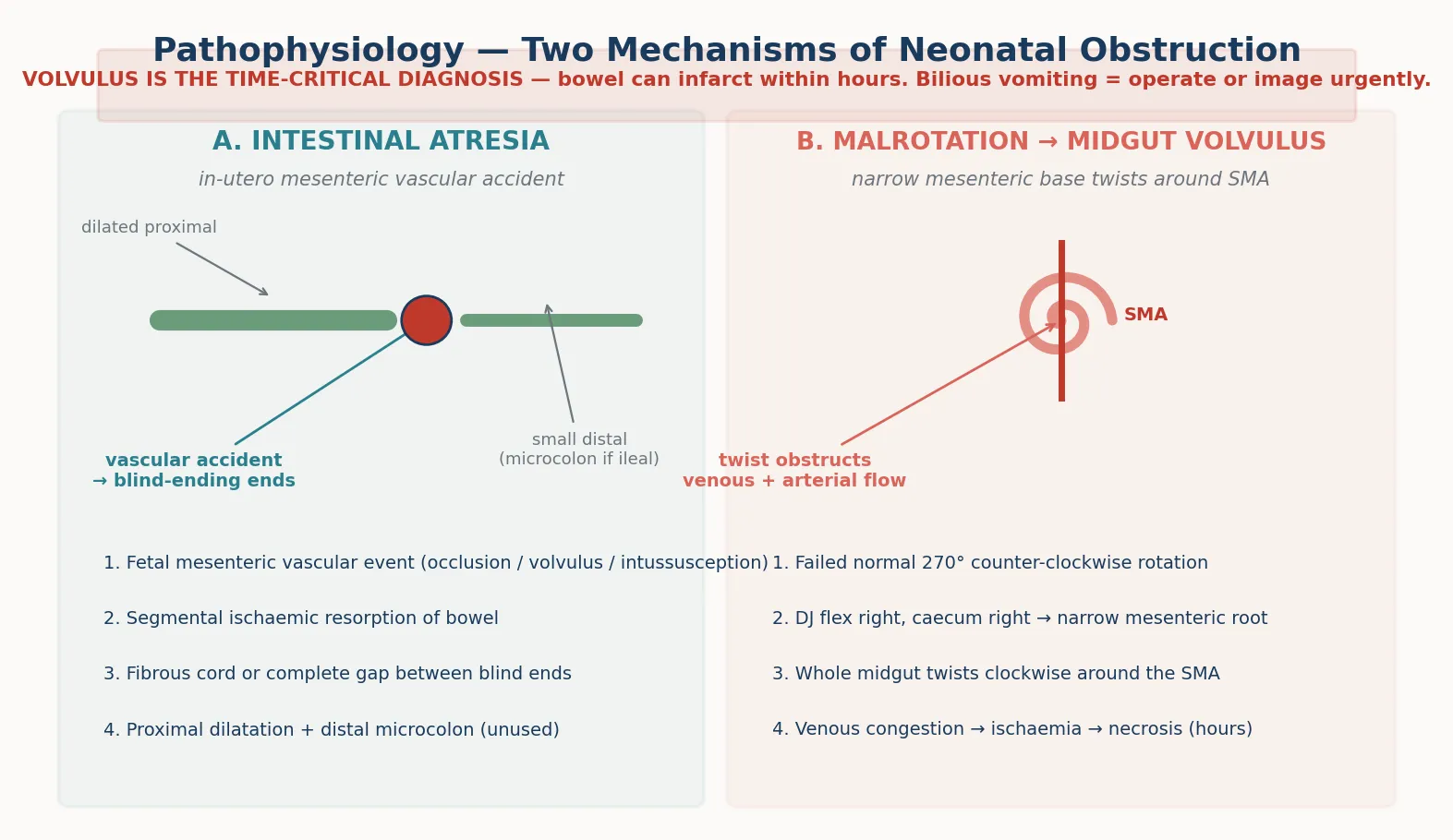 Educational schematic showing two mechanisms of neonatal obstruction — intestinal atresia from an in-utero mesenteric vascular accident with blind-ending segments, and malrotation with midgut volvulus twisting around the superior mesenteric artery producing venous congestion and ischaemia