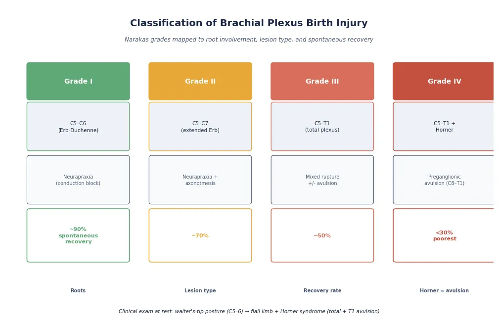 Narakas classification of brachial plexus birth injury grades I through IV, each mapped to the nerve root involvement (C5 to T1), the Seddon lesion type from neurapraxia through axonotmesis to neurotmesis, and the expected spontaneous recovery rate decreasing from ninety percent in grade I to under thirty percent in grade IV with Horner syndrome
