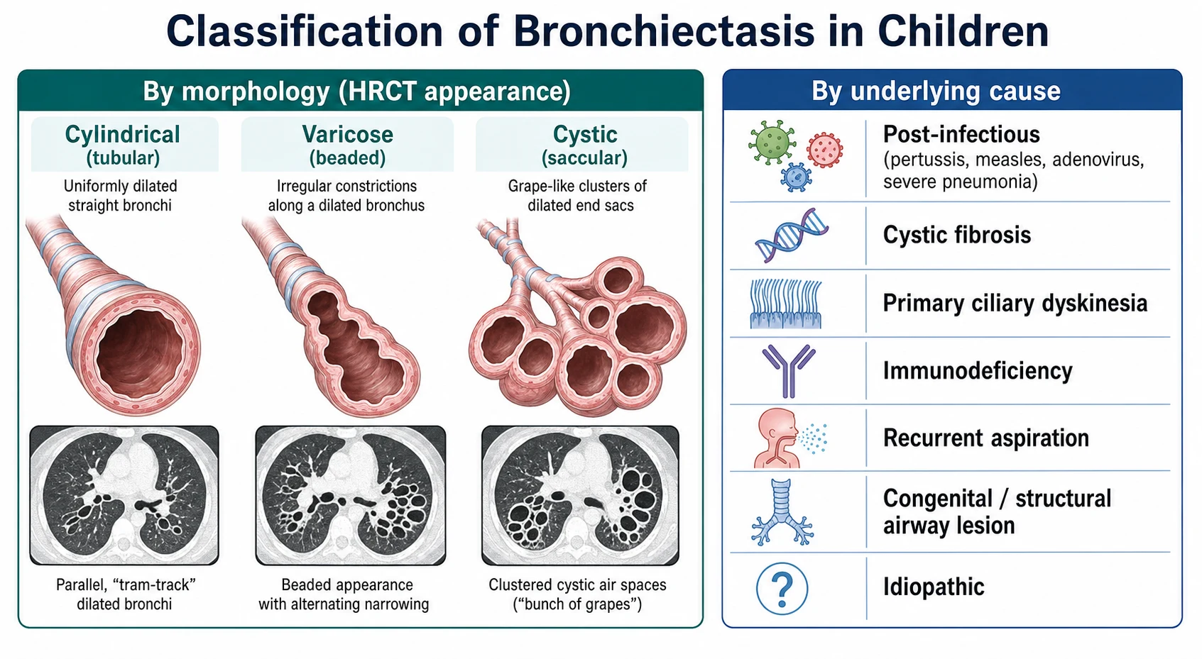 Classification of bronchiectasis in children by HRCT morphology (cylindrical, varicose, cystic) and by underlying cause (post-infectious, cystic fibrosis, primary ciliary dyskinesia, immunodeficiency, aspiration, congenital, idiopathic)