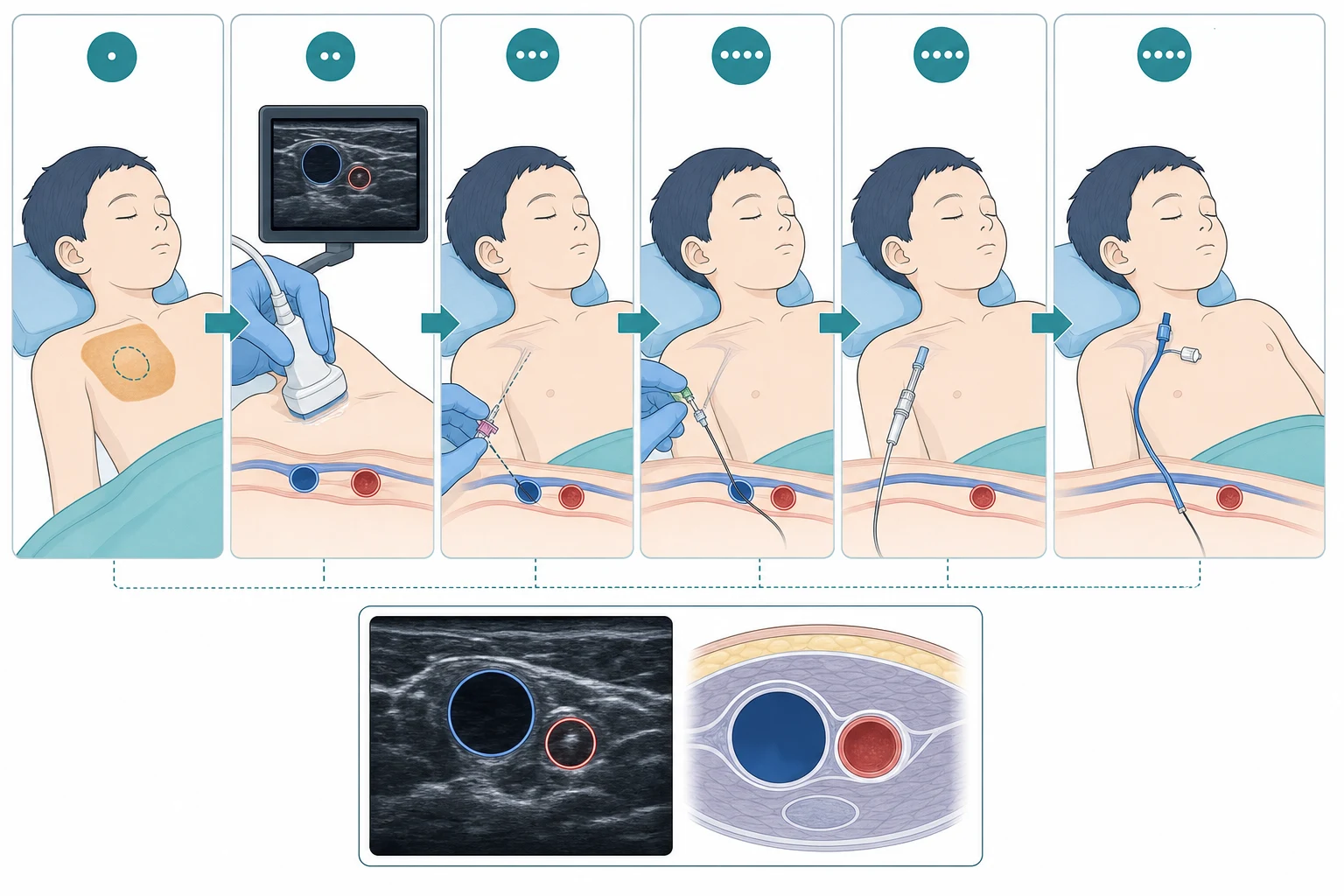 The Seldinger technique as a six-step left-to-right sequence from skin mark to secured catheter, with a short-axis ultrasound view of a round dark vein beside a pulsatile round artery beneath
