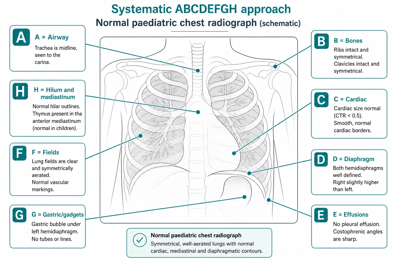 Annotated schematic line drawing of a normal paediatric chest radiograph with seven labelled callout boxes showing the systematic ABCDEFGH interpretation approach: airway, bones, cardiac, diaphragm, effusions, fields, gastric and gadgets, hilum and mediastinum