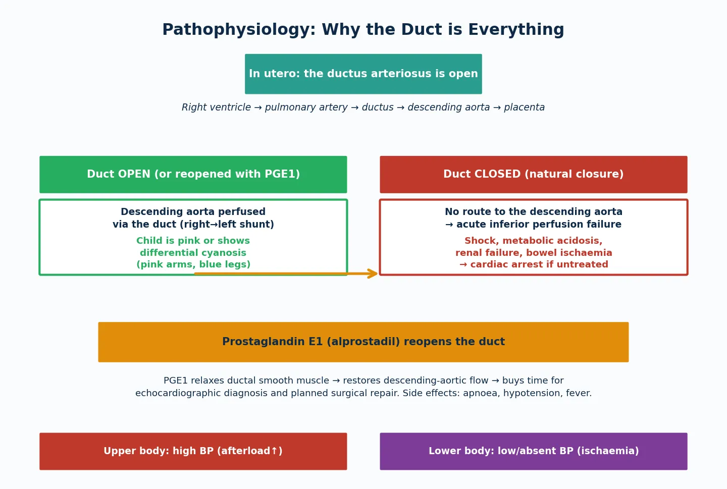 Pathophysiology of ductal-dependent arch obstruction. Top: in utero the ductus arteriosus is open, routing right ventricular output through the pulmonary artery and duct into the descending aorta and placenta. Left panel: with the duct open or reopened with prostaglandin E1, the descending aorta is perfused via a right-to-left ductal shunt and the child is pink or shows differential cyanosis (pink upper body, blue lower body). Right panel: with the duct closed by natural constriction, there is no route to the descending aorta, causing acute inferior perfusion failure with shock, metabolic acidosis, renal failure and bowel ischaemia, progressing to cardiac arrest. Bottom: prostaglandin E1 relaxes ductal smooth muscle to reopen the duct, restoring descending-aortic flow and buying time for diagnosis and planned surgery.