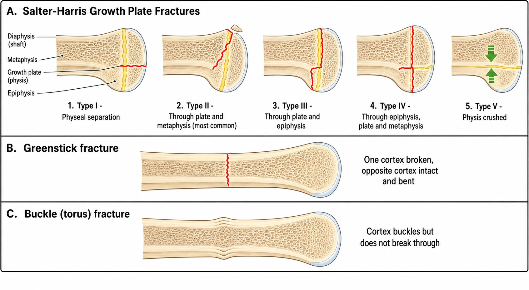 A labelled schematic of the five Salter-Harris growth-plate fracture types drawn on a bone cross-section showing the epiphysis, the yellow physis, the metaphysis and the shaft, each with its fracture line and type number, plus a greenstick fracture showing one cortex broken and one intact and bent, and a buckle or torus fracture showing the cortex crumpled without breaking through