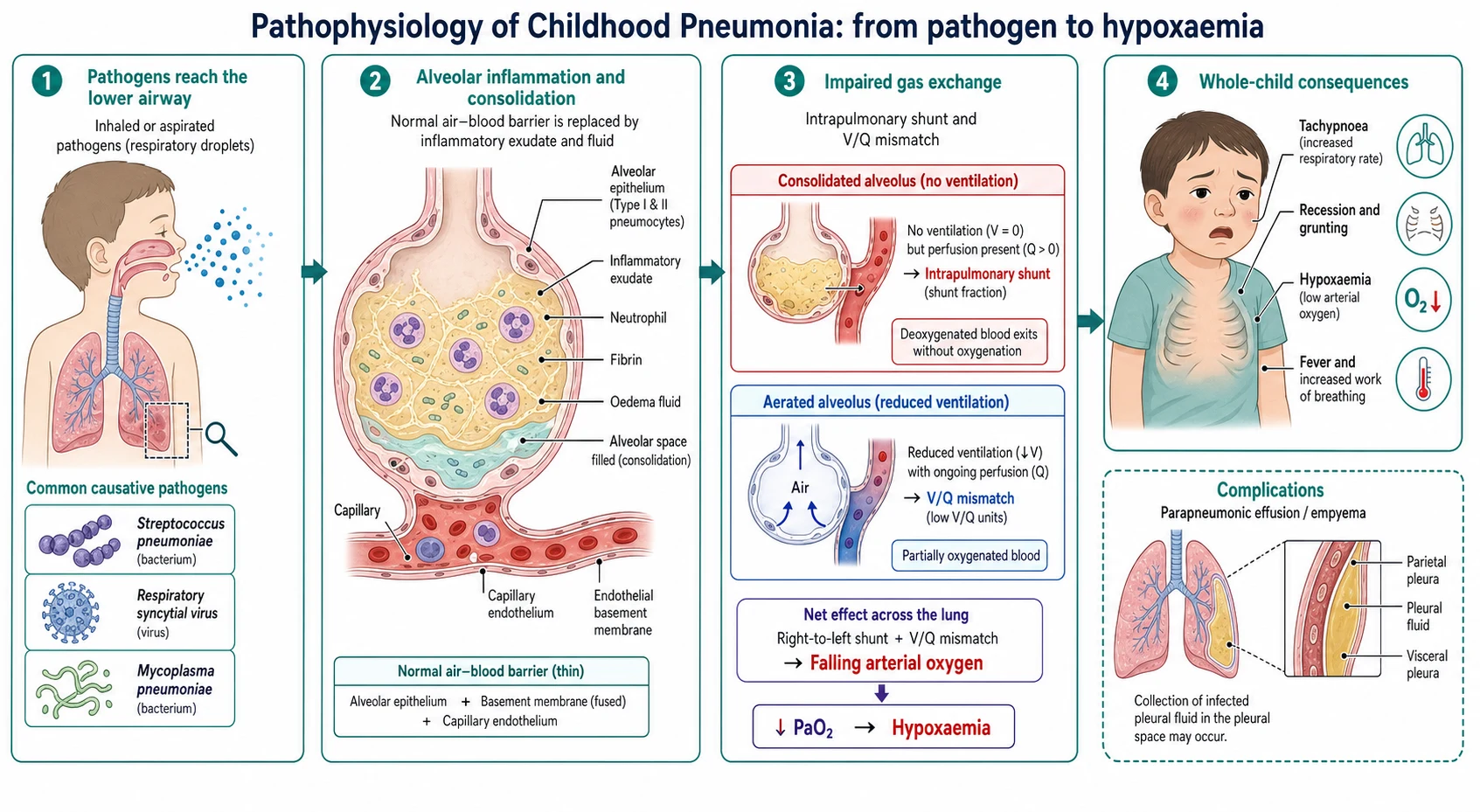 Educational mechanism schematic of childhood pneumonia showing pathogens reaching the alveolus, alveolar filling with inflammatory exudate and consolidation, ventilation-perfusion mismatch and shunt causing hypoxaemia, the resulting tachypnoea and increased work of breathing, and a side panel on parapneumonic effusion and empyema