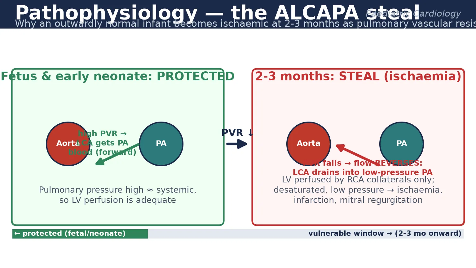 Educational mechanism schematic of the ALCAPA steal showing the fetal and early neonatal period when high pulmonary vascular resistance drives forward flow from the pulmonary artery into the left coronary artery protecting the myocardium, contrasted with the two- to three-month period when falling pulmonary vascular resistance reverses flow so the left coronary artery drains into the low-pressure pulmonary artery, leaving the left ventricle perfused only by right coronary collaterals at low pressure and producing ischaemia and infarction