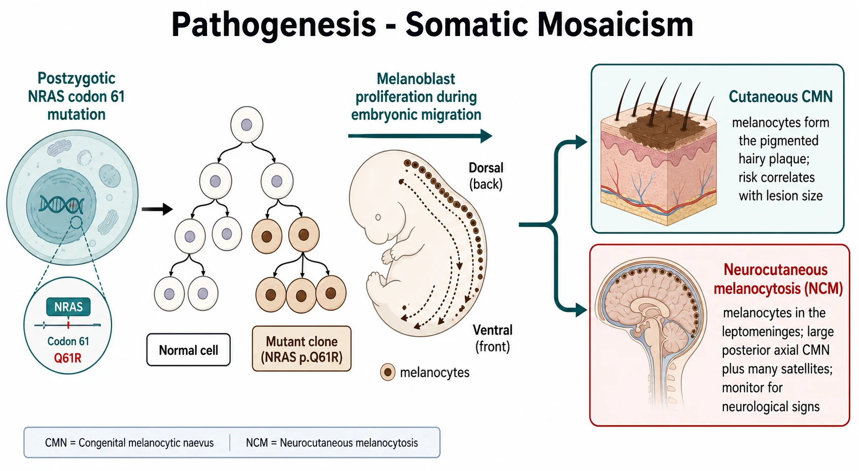 A clean educational medical mechanism diagram in a flat illustration style explaining the pathogenesis of congenital melanocytic naevi. Left: a stylised cell with a highlighted gene icon labelled Postzygotic NRAS codon 61 mutation, beside a branching mosaicism tree showing a normal cell in white and the mutant clone (NRAS p.Q61R) shaded. Middle: an arrow labelled Melanoblast proliferation during embryonic migration showing the neural-crest-derived melanocytes migrating from dorsal to ventral along a simplified embryo outline (dotted arrows) and accumulating in the dermis and epidermis. Right: two stacked outcome boxes: the top box labelled Cutaneous CMN - melanocytes form the pigmented hairy plaque, risk correlates with the lesion size; the bottom box labelled Neurocutaneous melanocytosis (NCM) - melanocytes in the leptomeninges, large posterior axial CMN plus many satellites, monitor for neurological signs. Clear sans-serif labels, clinical palette.