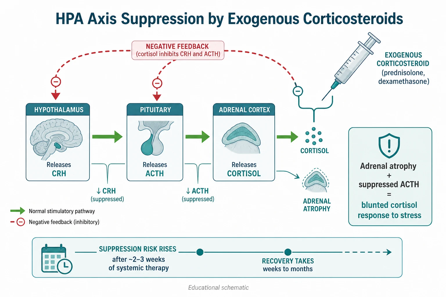 Educational schematic of the hypothalamic-pituitary-adrenal axis showing CRH to ACTH to cortisol forward arrows with a negative-feedback loop, and a syringe of exogenous corticosteroid feeding the feedback pathway to suppress CRH and ACTH, causing adrenal cortical atrophy and a blunted cortisol response to stress