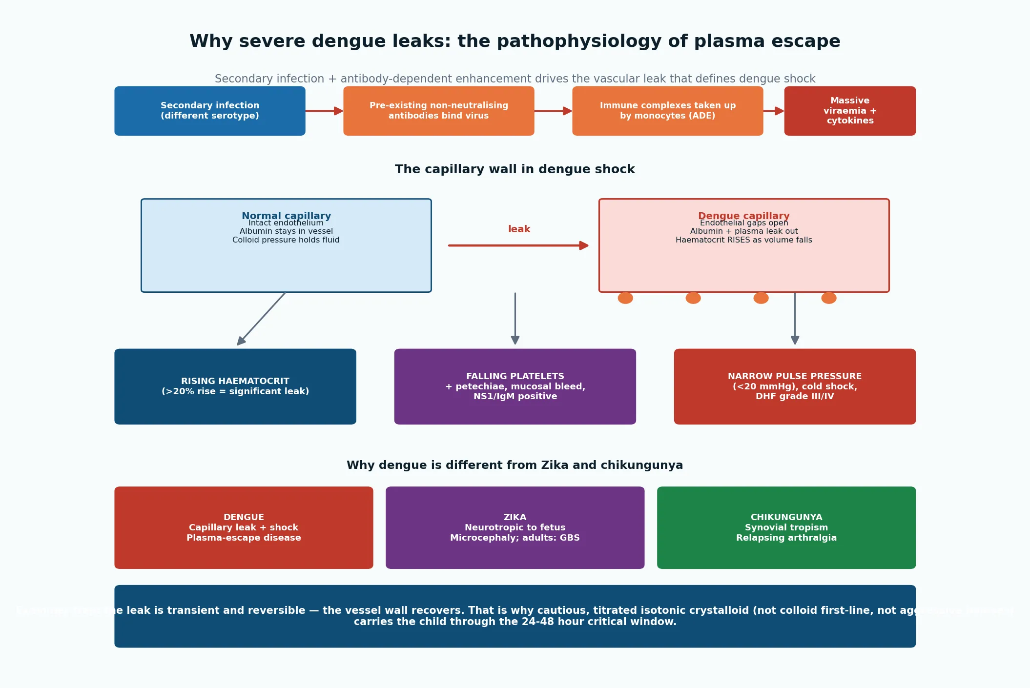 Pathophysiology of dengue plasma leakage from secondary infection and antibody-dependent enhancement through immune-complex uptake in monocytes, massive viraemia and cytokine release, to endothelial gap formation, albumin escape, rising haematocrit and falling platelets, with a contrast to Zika fetal neurotropism and chikungunya synovial tropism.