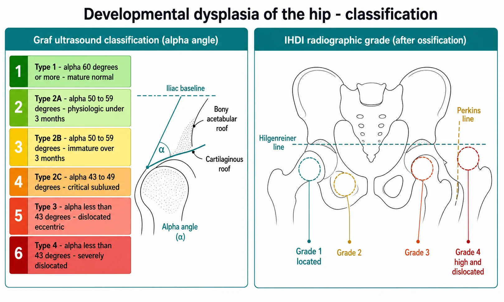 Two-panel schematic. Left panel titled Graf ultrasound classification alpha angle shows six coloured rows: green Type 1 alpha 60 degrees or more mature normal, light green Type 2A alpha 50 to 59 degrees physiologic under 3 months, yellow Type 2B alpha 50 to 59 degrees immature over 3 months, orange Type 2C alpha 43 to 49 degrees critical subluxed, red Type 3 alpha less than 43 degrees dislocated eccentric, dark red Type 4 alpha less than 43 degrees severely dislocated, beside a coronal hip ultrasound line diagram with iliac baseline, bony acetabular roof, cartilaginous roof and alpha angle. Right panel titled IHDI radiographic grade shows an anteroposterior pelvis with a horizontal Hilgenreiner line and a vertical Perkins line, femoral head in four positions Grade 1 located, Grade 2, Grade 3, Grade 4 high and dislocated.