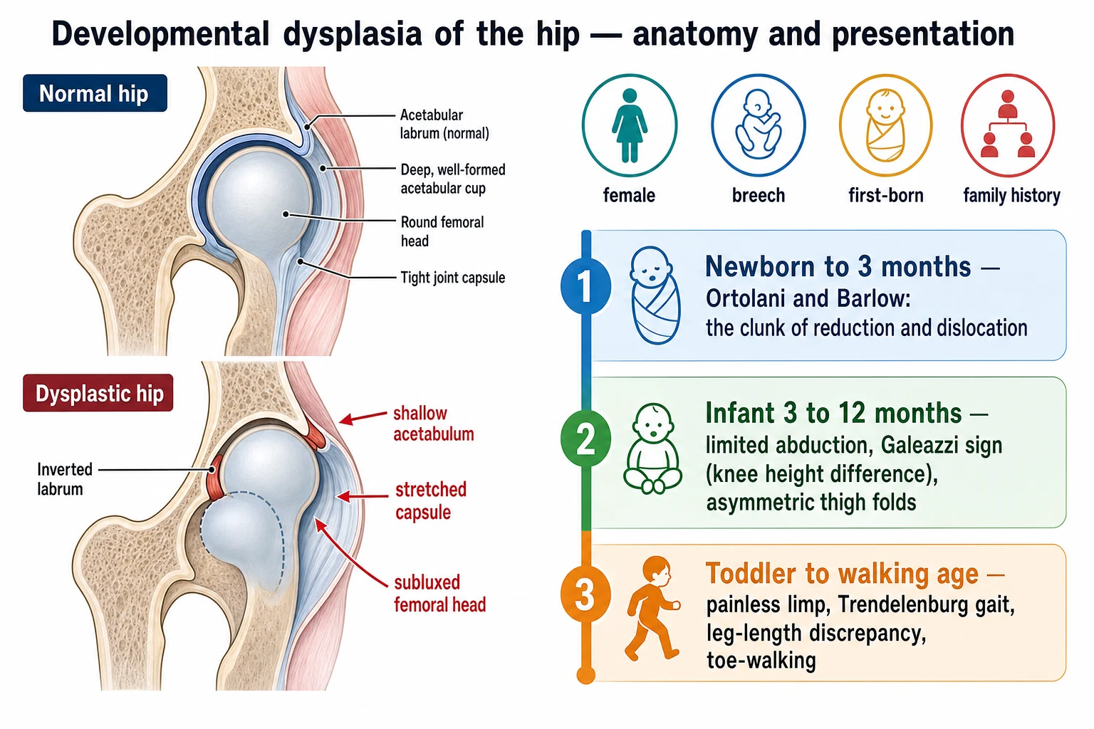 Two-section schematic. Left section shows a normal hip cross-section with a deep well-formed acetabular cup, round femoral head, normal labrum and tight capsule, beside a dysplastic hip cross-section with a shallow acetabulum, inverted labrum, stretched capsule and an upwardly subluxed femoral head, with arrows pointing to shallow acetabulum, stretched capsule and subluxed femoral head. Right section shows an age-of-presentation timeline of three bands: band one blue newborn to 3 months reads Ortolani and Barlow the clunk of reduction and dislocation; band two green infant 3 to 12 months reads limited abduction Galeazzi sign knee height difference asymmetric thigh folds; band three orange toddler to walking age reads painless limp Trendelenburg gait leg-length discrepancy toe-walking. Above the timeline four risk-factor icons read female breech first-born family history.