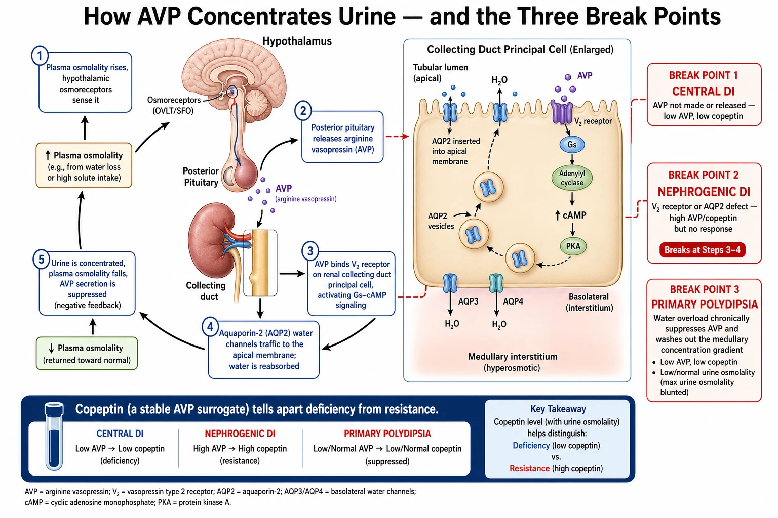 Pathophysiology diagram of the vasopressin-water balance loop in five steps: plasma osmolality rises and hypothalamic osmoreceptors sense it; the posterior pituitary releases arginine vasopressin; vasopressin binds the V2 receptor on the collecting duct principal cell generating cyclic AMP; aquaporin-2 water channels traffic to the apical membrane and water is reabsorbed; urine concentrates and vasopressin secretion is suppressed by negative feedback. Three red break points are marked: central diabetes insipidus breaks at step 2 (no vasopressin made or released, low copeptin); nephrogenic diabetes insipidus breaks at steps 3 to 4 (V2 receptor or aquaporin-2 defect, high copeptin but no response); primary polydipsia chronically suppresses vasopressin from water overload and washes out the medullary gradient. An inset shows the principal cell with the V2 receptor, Gs-cAMP, aquaporin-2 vesicles inserting apically, and basolateral aquaporin-3 and aquaporin-4.