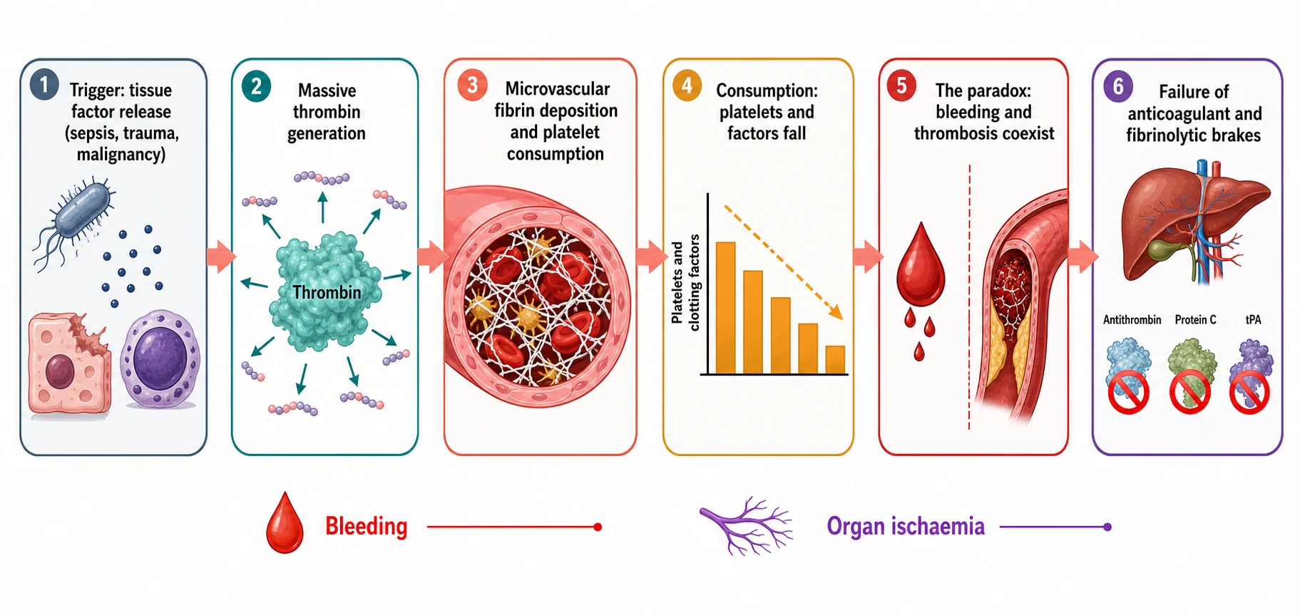 A clean scientific pathophysiology cascade on a white background. Six connected rounded boxes flow left to right joined by coral arrows. Box one in slate shows a bacterium, a damaged tissue cell, and a leukaemic blast labelled trigger tissue factor release. Box two in teal shows a thrombin molecule with many cleavage arrows labelled massive thrombin generation. Box three in coral shows a fibrin mesh with trapped red cells in a small vessel labelled microvascular fibrin deposition and platelet consumption. Box four in amber shows a falling bar chart of platelets and factors labelled consumption. Box five in red shows a split pathway with a bleeding droplet and a blocked ischaemic vessel labelled the paradox bleeding and thrombosis coexist. Box six in purple shows a crossed-out antithrombin, protein C, and tissue plasminogen activator labelled failure of the anticoagulant and fibrinolytic brakes.