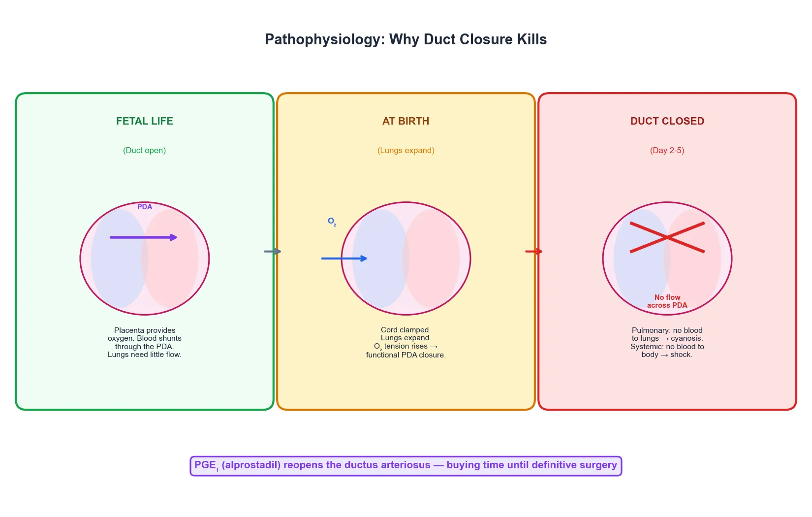 Pathophysiology showing fetal circulation with the placenta providing oxygen and the ductus arteriosus shunting blood, the transition at birth when lungs expand and oxygen tension rises causing functional duct closure, and day 2 to 5 when the duct closes anatomically leaving no route for pulmonary blood in right-sided obstruction or systemic blood in left-sided obstruction. Prostaglandin E1 reopens the duct.