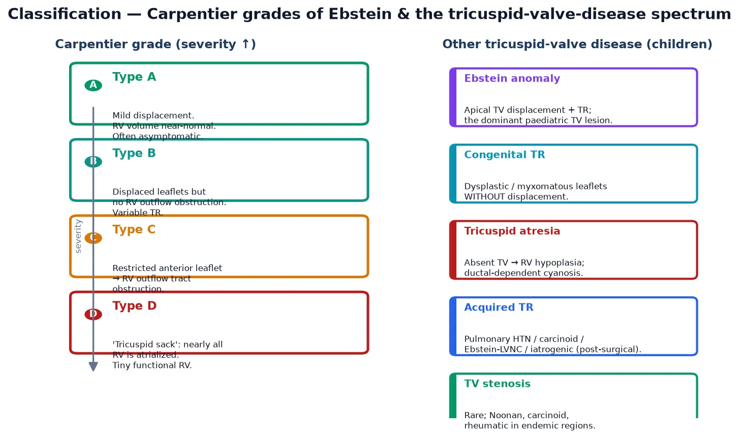Classification of Ebstein anomaly and the wider tricuspid-valve-disease spectrum. Left panel: the four Carpentier grades of Ebstein anomaly by ascending severity — type A with mild tricuspid-valve displacement and a near-normal right ventricular volume, often asymptomatic; type B with apically displaced leaflets but no right-ventricular outflow obstruction and variable tricuspid regurgitation; type C with a restricted, adherent anterior leaflet causing right-ventricular outflow tract obstruction; and type D, the tricuspid sack, in which nearly the entire right ventricle is atrialised and the functional right ventricle is tiny. Right panel: the other tricuspid-valve diseases of childhood — Ebstein anomaly as the dominant lesion, congenital tricuspid regurgitation from dysplastic or myxomatous leaflets without displacement, tricuspid atresia with an absent valve and a hypoplastic right ventricle producing ductal-dependent cyanosis, acquired tricuspid regurgitation from pulmonary hypertension, carcinoid or post-surgical causes, and the rare tricuspid stenosis of Noonan syndrome, carcinoid and rheumatic disease.