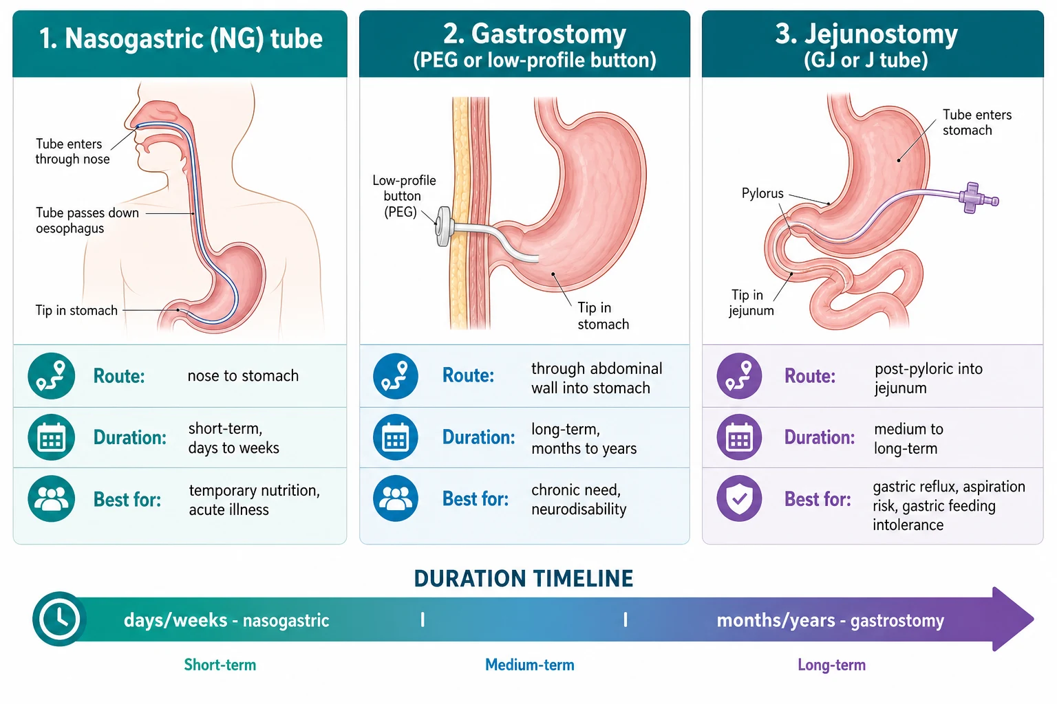 Classification of paediatric enteral feeding access by route and duration in three columns: nasogastric tube from nose to stomach for short-term days to weeks, gastrostomy through the abdominal wall into the stomach as a percutaneous endoscopic gastrostomy or low-profile balloon button for long-term months to years, and jejunostomy or gastrojejunostomy passing post-pyloric into the jejunum for reflux and aspiration, with a duration timeline bar beneath