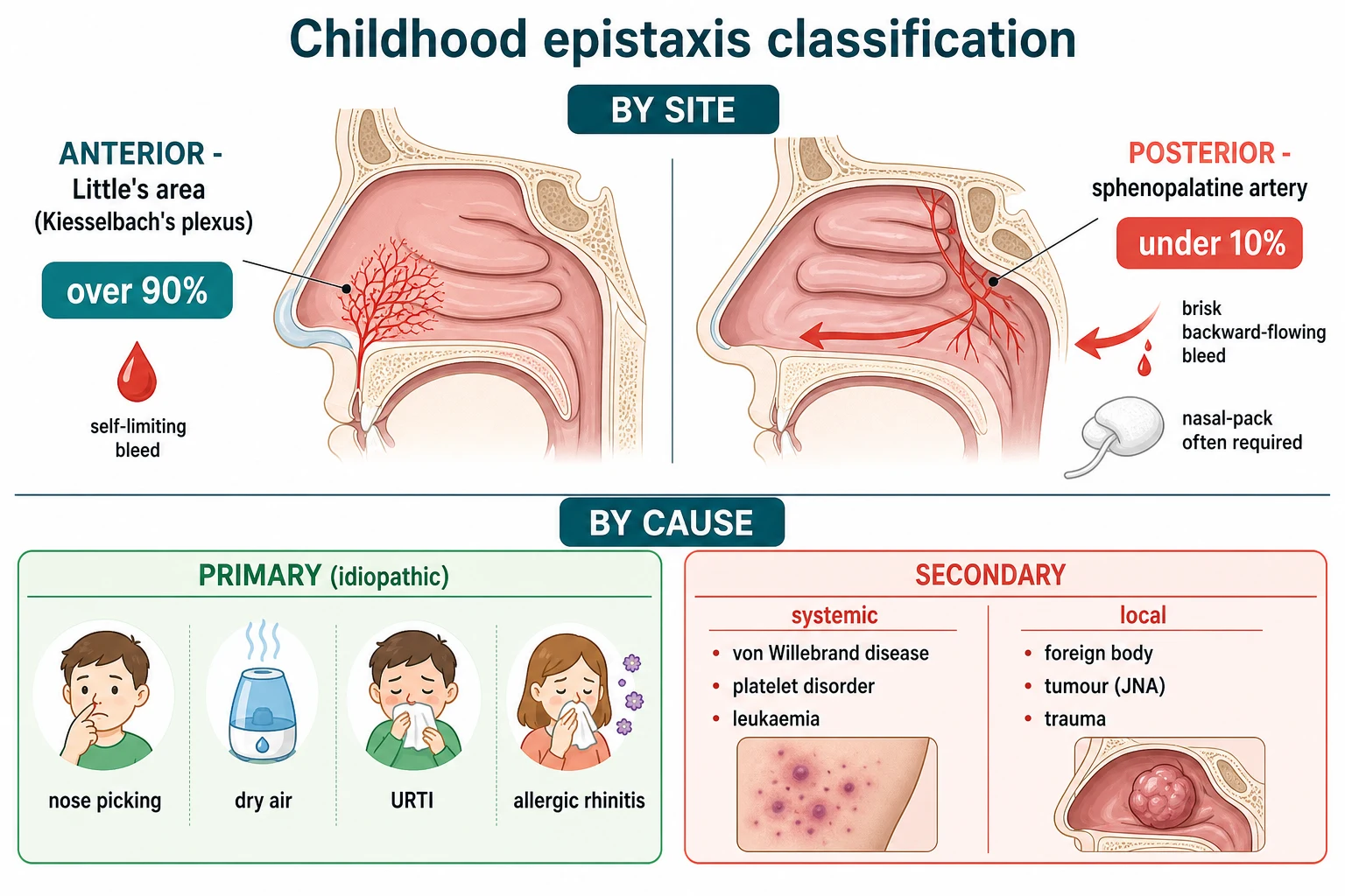 Two-row schematic of childhood epistaxis classification: top row anterior versus posterior — anterior Little's area on the anteroinferior septum labelled over 90 percent with a small self-limiting bleed icon, posterior sphenopalatine artery behind the middle turbinate labelled under 10 percent with a brisk backward-flowing bleed and a packing icon; bottom row primary versus secondary causes — primary idiopathic with nose-picking, dry-air, URTI and allergic-rhinitis icons, and secondary systemic (von Willebrand, platelet, leukaemia) and local (foreign body, tumour, trauma) icons.