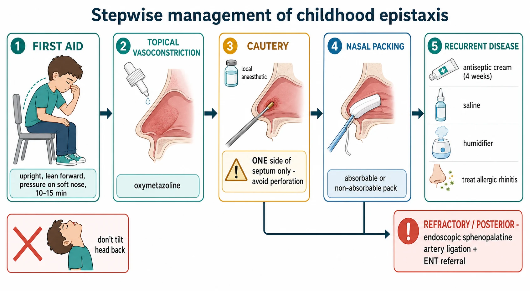 Stepwise left-to-right management pathway for childhood epistaxis: step one first aid — a child seated upright leaning forward with a hand firmly pinching the soft lower nose labelled 10 to 15 minutes; step two topical vasoconstriction — oxymetazoline applied to the mucosa; step three silver-nitrate cautery — applicator to one anterior septal surface under local anaesthesia with a one-side-of-septum warning icon; step four nasal packing — an absorbable tampon being inserted; step five recurrent disease — antiseptic cream to the septum, saline, humidifier and treat-allergic-rhinitis icons; and a refractory lane to endoscopic sphenopalatine artery ligation and ENT referral, with a crossed-out tilt-the-head-back icon marking the common error.