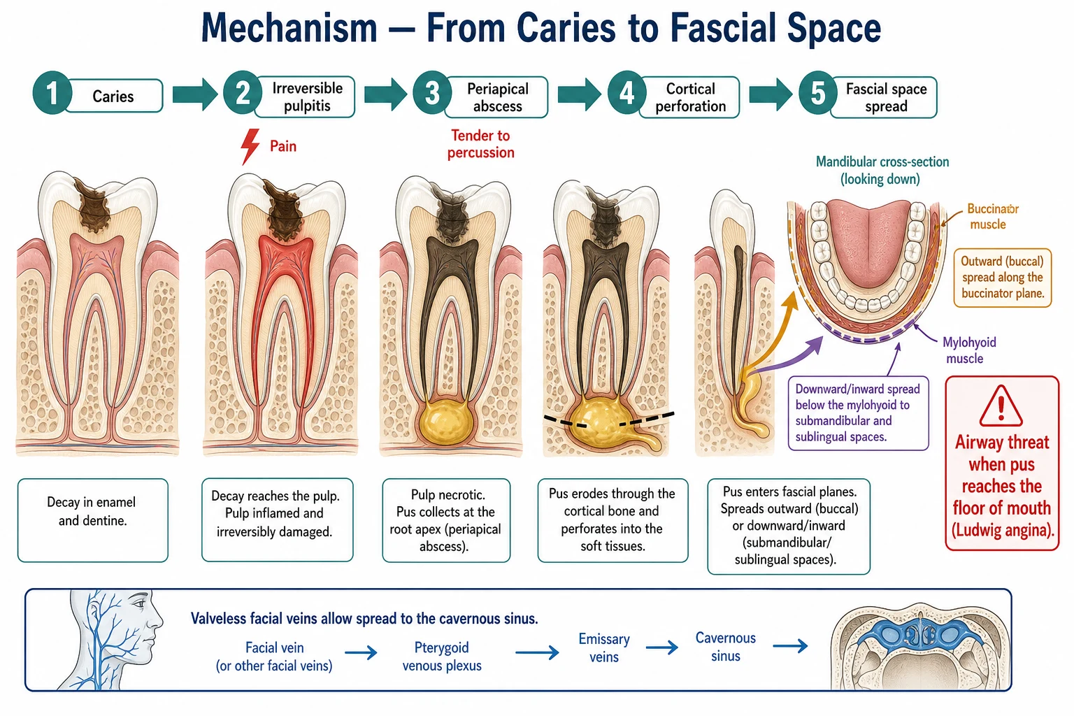 Educational mechanism schematic showing the causal chain from dental caries through irreversible pulpitis and periapical abscess to cortical perforation and fascial-space spread, with a mandibular cross-section illustrating how the buccinator and mylohyoid attachments determine whether infection tracks buccally into the cheek or lingually into the floor of mouth