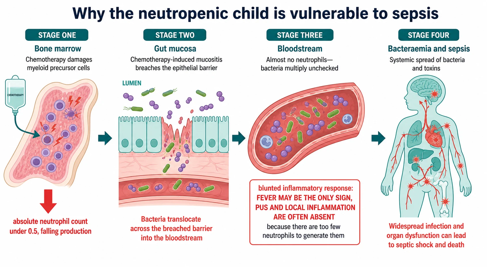 A clean medical-education pathophysiology schematic on a white background showing a left-to-right pipeline of why the neutropenic child is vulnerable to sepsis. Stage one is the bone marrow with chemotherapy damaging myeloid precursors and a downward arrow showing falling neutrophil production labelled absolute neutrophil count under 0.5. Stage two is the gut mucosa with chemotherapy-induced mucositis showing a breached epithelial barrier and bacteria as green rods and purple cocci translocating across into the blood. Stage three is a blood vessel nearly empty of neutrophils so bacteria multiply unchecked with a red callout blunted inflammatory response fever and pus may be the only sign. Stage four is bacteraemia and sepsis. Teal for healthy tissue coral for infection.