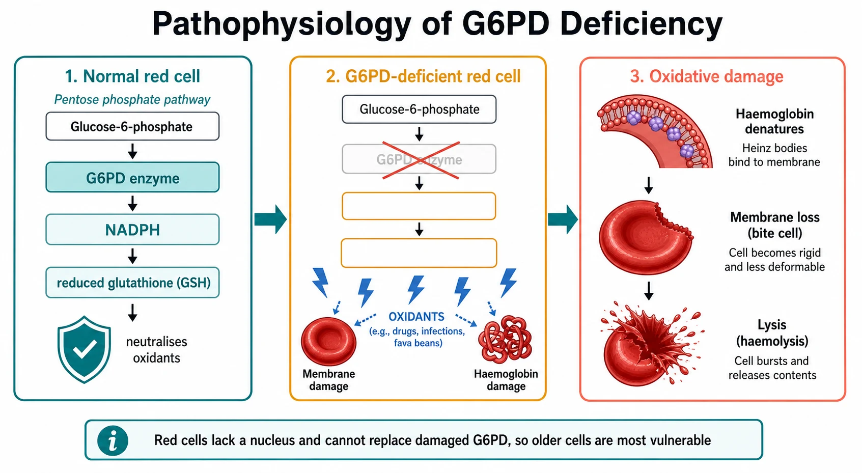 A clean medical-education pathophysiology schematic on a white background in three panels showing the normal red cell with the pentose phosphate pathway running from glucose-6-phosphate through the G6PD enzyme to NADPH to reduced glutathione GSH that neutralises oxidants, then the G6PD-deficient red cell with the failed enzyme and lost NADPH and glutathione allowing oxidants to damage the membrane and haemoglobin, then oxidative damage with denatured haemoglobin forming Heinz bodies bound to the membrane, splenic pitting producing bite cells, and finally cell lysis.