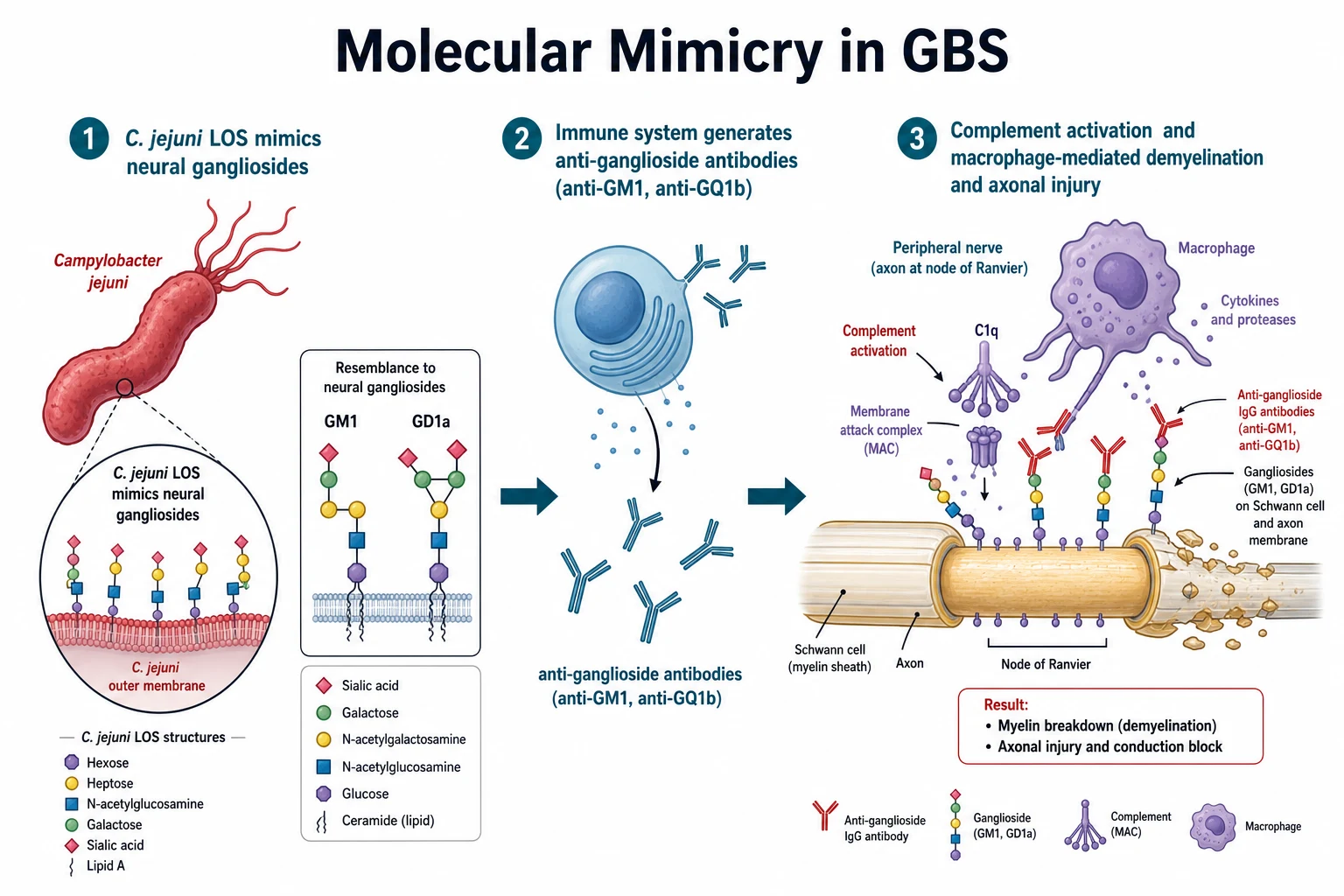 A pathophysiology mechanism diagram on a white background in three sequential panels. Left shows a Campylobacter jejuni bacterium in red with a magnified inset of its lipo-oligosaccharide mimicking neural gangliosides GM1 and GD1a. Middle shows the immune system generating Y-shaped anti-ganglioside IgG antibodies. Right shows a peripheral nerve axon at a node of Ranvier with antibodies binding its surface, complement forming the membrane attack complex, and a macrophage stripping myelin and severing the axon.