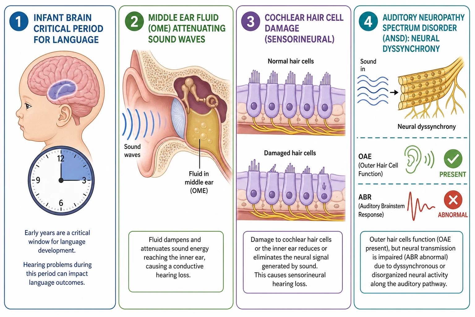 Four-panel educational schematic of critical period language access, conductive middle-ear attenuation, cochlear sensorineural injury, and auditory neuropathy dyssynchrony
