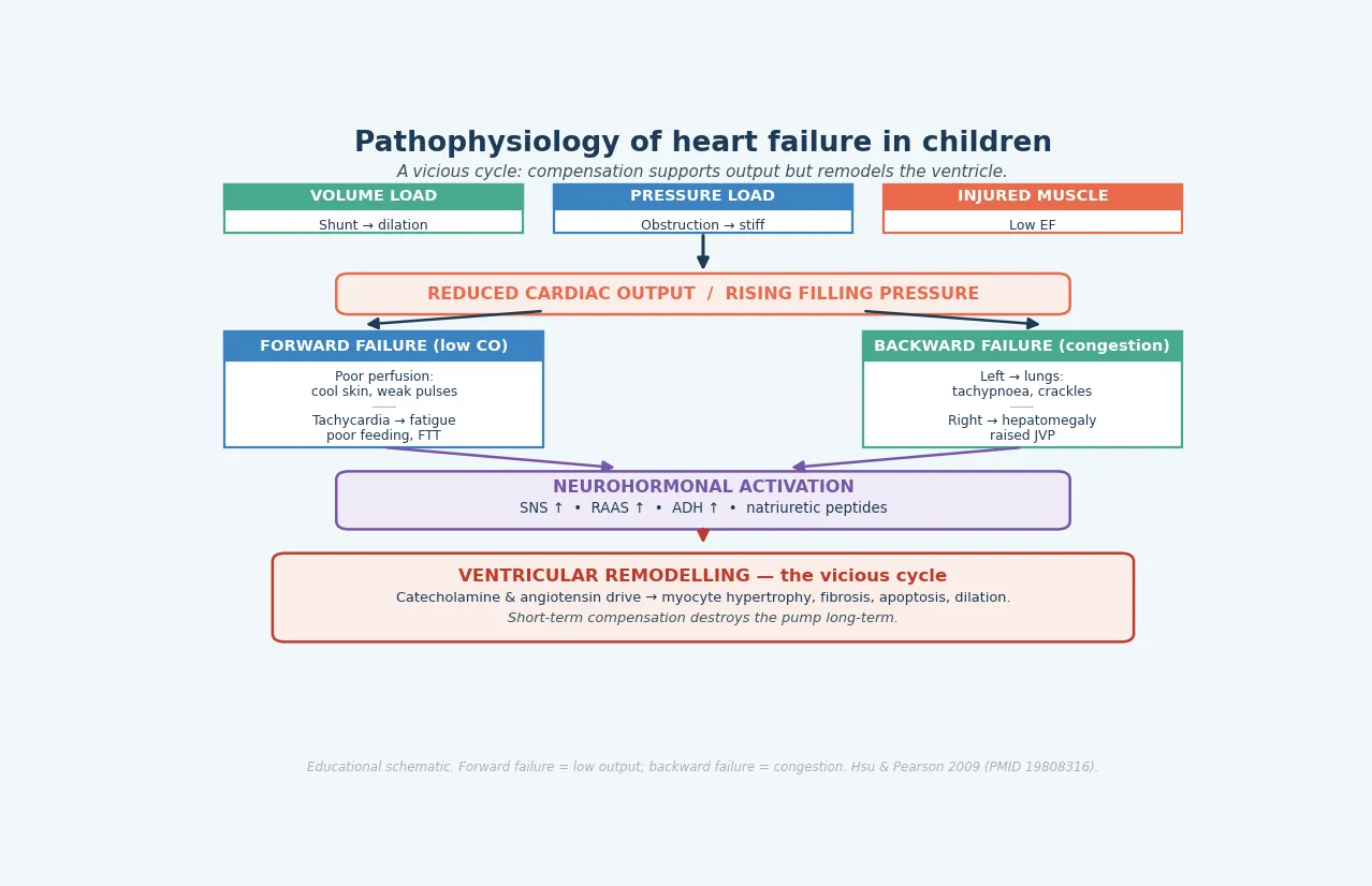 Pathophysiology of paediatric heart failure showing the forward (low output) and backward (congestion) failure modes converging on neurohormonal activation (SNS, RAAS, ADH), which briefly supports output but drives the vicious cycle of ventricular remodelling that neurohormonal blockade is designed to interrupt