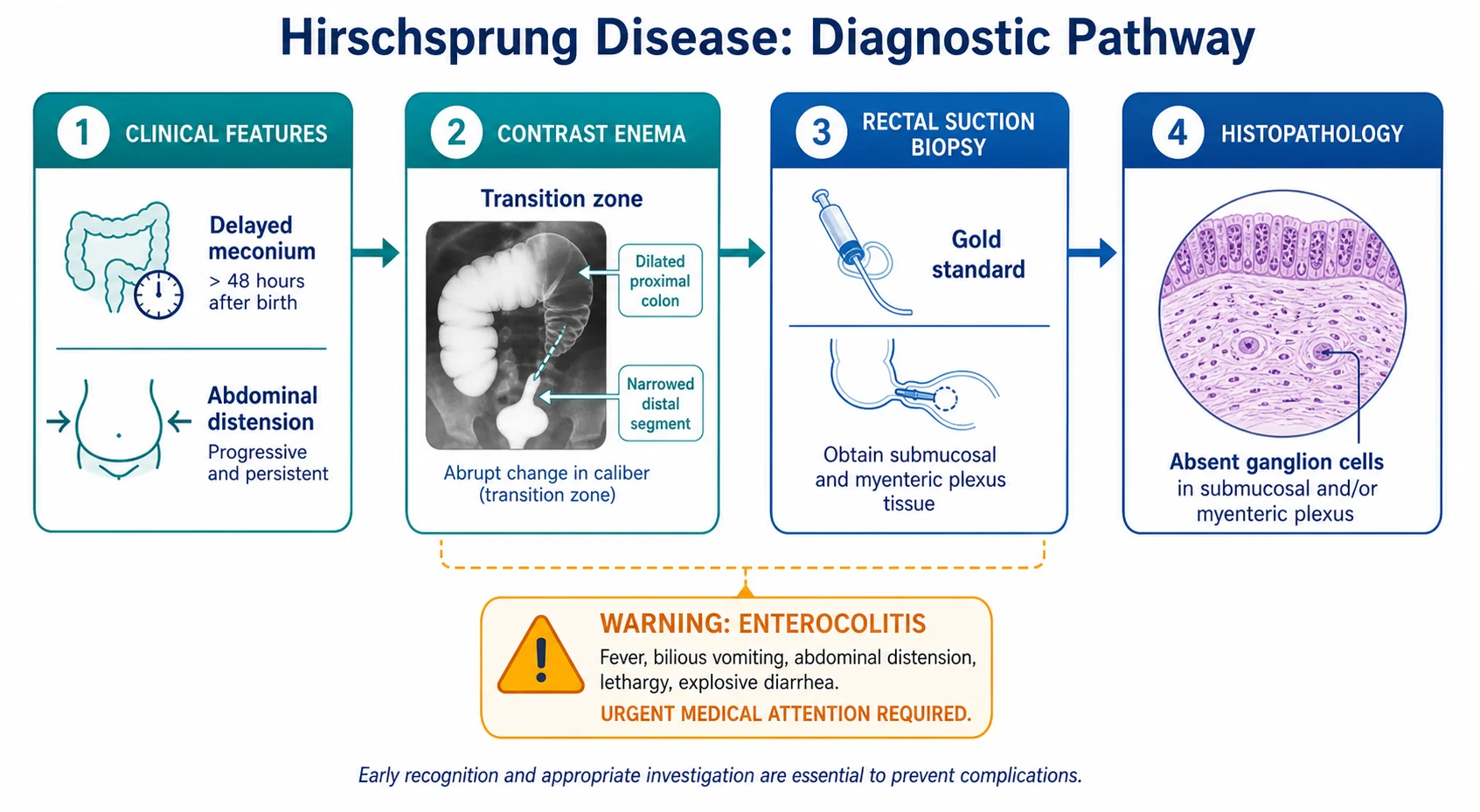 Diagnostic pathway flowchart for Hirschsprung disease, showing four connected stages from clinical features of delayed meconium and distension, through contrast enema showing transition zone, to rectal suction biopsy as gold standard, and histopathology showing absent ganglion cells. A separate amber warning branch highlights Hirschsprung-associated enterocolitis with fever, explosive diarrhoea and distension.