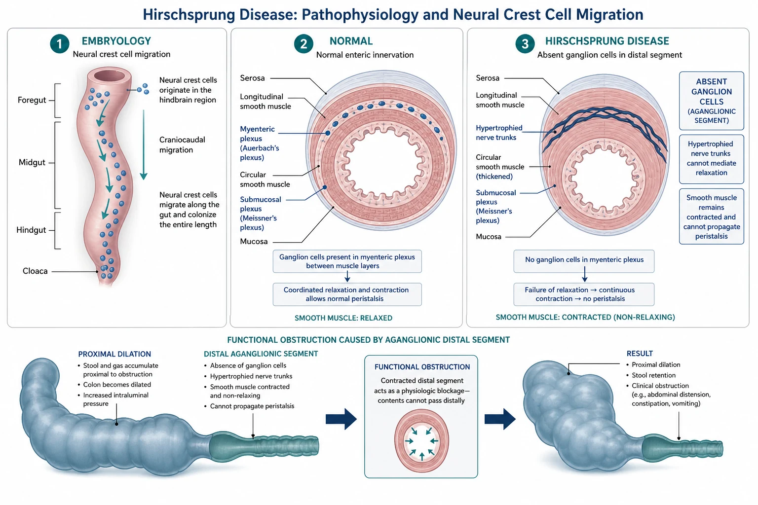 Three-panel pathophysiology diagram of Hirschsprung disease. Panel one shows neural crest cells migrating craniocaudally along the developing fetal gut during weeks five to twelve. Panel two shows a normal intestinal wall cross-section with ganglion cells present in the myenteric and submucosal plexuses between muscle layers. Panel three shows the aganglionic segment with absent ganglion cells, hypertrophied nerve trunks and non-relaxing contracted smooth muscle causing functional obstruction.