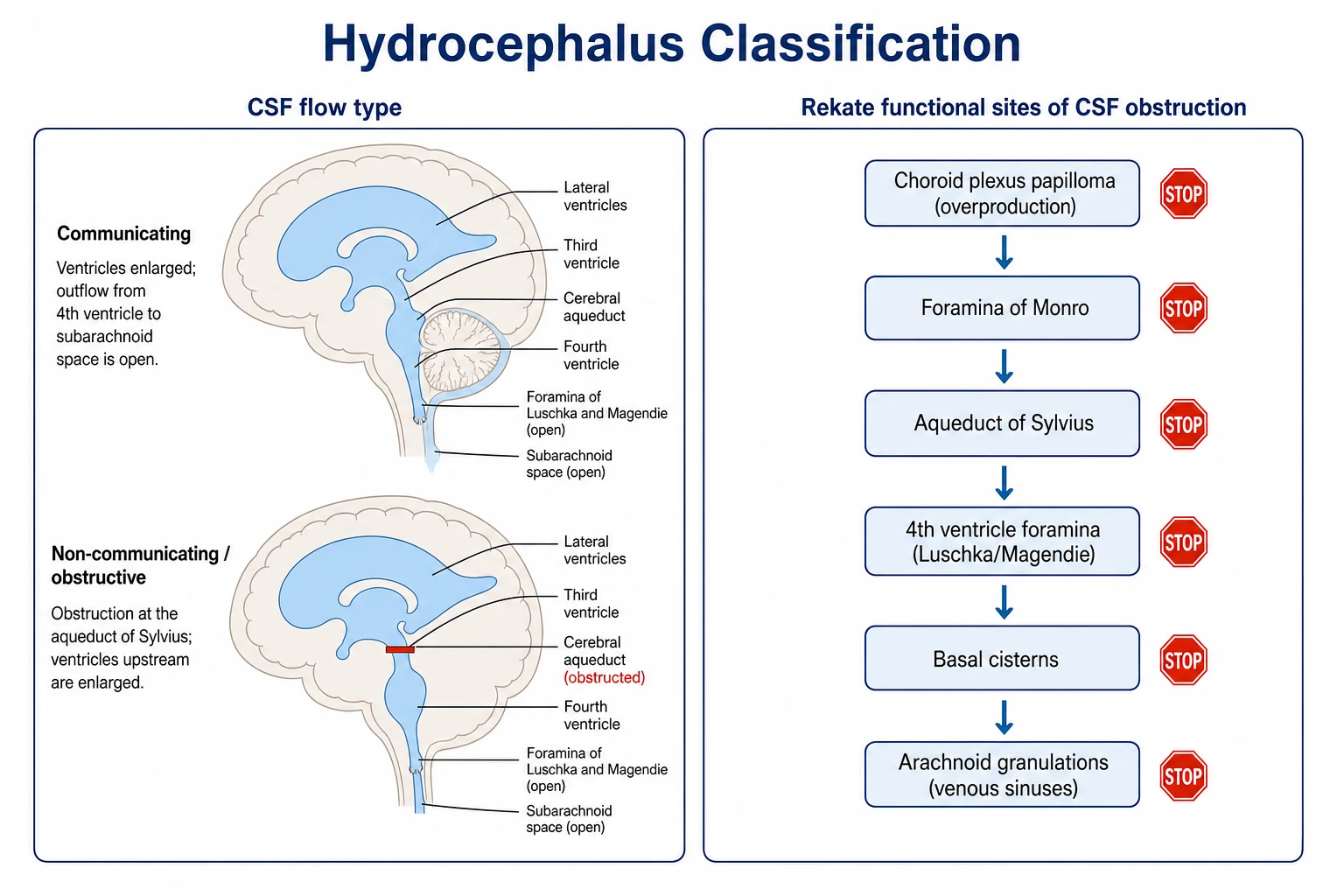 A clean medical schematic on a white background titled Hydrocephalus Classification. The left panel shows the communicating versus non-communicating or obstructive distinction, with a red blockage bar across the aqueduct for the obstructive form and ballooned upstream ventricles. The right panel shows the Rekate functional sites of cerebrospinal fluid disturbance from the foramina of Monro, the aqueduct of Sylvius, the fourth ventricle outlets, the basal cisterns, and the arachnoid granulations, with a sixth node for choroid plexus papilloma overproduction.