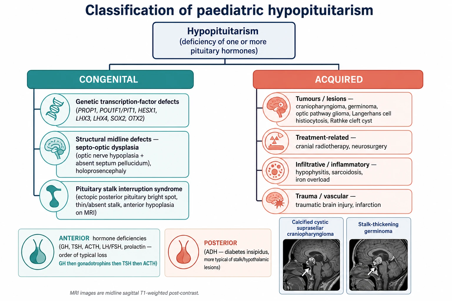Classification tree of paediatric hypopituitarism. The congenital column lists genetic transcription-factor defects (PROP1, POU1F1, HESX1, LHX3, LHX4, SOX2, OTX2), midline structural defects (septo-optic dysplasia with optic nerve hypoplasia and absent septum pellucidum, holoprosencephaly) and pituitary stalk interruption syndrome with an ectopic posterior pituitary bright spot. The acquired column lists tumours and lesions (craniopharyngioma, germinoma, optic pathway glioma, Langerhans cell histiocytosis, Rathke cleft cyst), treatment-related causes (cranial radiotherapy, neurosurgery), infiltrative and inflammatory causes (hypophysitis, sarcoidosis, iron overload) and trauma or vascular causes. A legend separates anterior deficiencies (growth hormone, gonadotrophins, thyroid-stimulating hormone, adrenocorticotrophin, prolactin) from posterior diabetes insipidus.