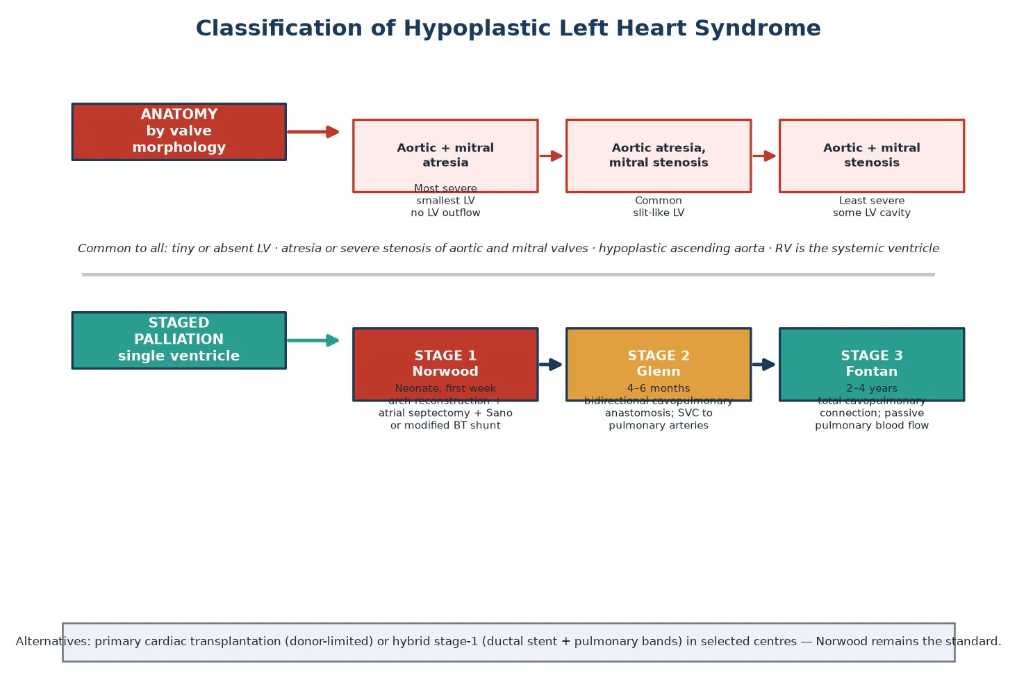 Two-row classification of hypoplastic left heart syndrome. Top row, anatomy by valve morphology: aortic and mitral atresia is the most severe form with the smallest left ventricle and no left-ventricular outflow; aortic atresia with mitral stenosis is the commonest form with a small slit-like left ventricle; aortic and mitral stenosis is the least severe form with some left-ventricular cavity. Common to all forms are atresia or severe stenosis of the aortic and mitral valves, a hypoplastic ascending aorta, and a right ventricle that is the systemic ventricle. Bottom row, staged single-ventricle palliation: stage one Norwood in the first week with arch reconstruction, atrial septectomy and a right-ventricle-to-pulmonary-artery Sano conduit or modified Blalock-Taussig shunt; stage two bidirectional Glenn at four to six months connecting the superior vena cava to the pulmonary arteries; stage three Fontan at two to four years creating a total cavopulmonary connection with passive pulmonary blood flow. Alternatives of primary cardiac transplantation or a hybrid stage one are noted.