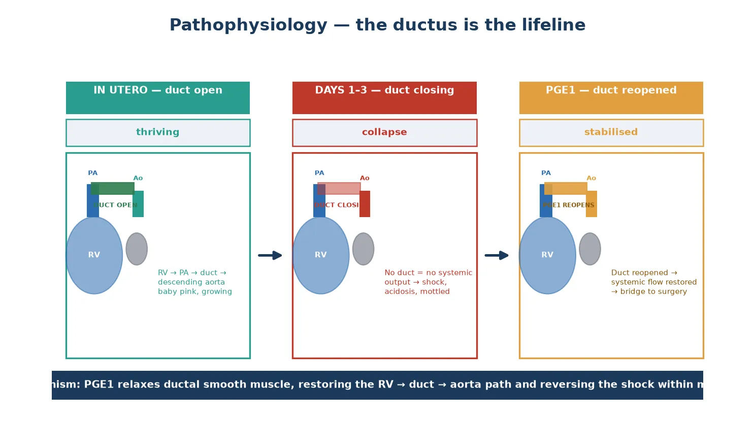 Three-panel pathophysiology of hypoplastic left heart syndrome. Left panel, in utero with the duct open: right ventricle ejects into the pulmonary artery, blood crosses the open ductus arteriosus into the descending aorta and retrograde up the hypoplastic arch to the head, neck and coronaries; the baby is pink and growing. Middle panel, days one to three with the duct closing: the only route to systemic blood flow is lost, causing acute low cardiac output with shock, metabolic acidosis, mottled skin and weak pulses. Right panel, prostaglandin E1 reopening the duct: ductal smooth muscle relaxes, the right-ventricle-to-duct-to-aorta circuit is restored, systemic output recovers and the baby is stabilised as a bridge to surgery. The bottom strip states that prostaglandin E1 relaxes ductal smooth muscle, restoring the right-ventricle to duct to aorta path and reversing the shock within minutes.
