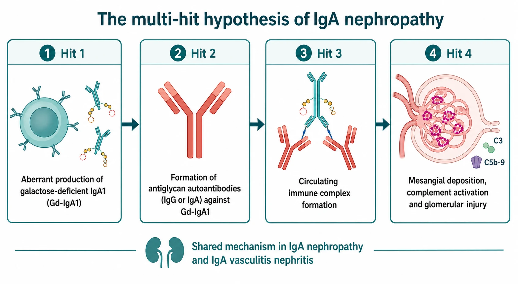 Pathophysiology diagram of the multi-hit hypothesis. Hit 1, aberrant production of galactose-deficient IgA1 (Gd-IgA1) by B cells. Hit 2, formation of antiglycan autoantibodies (IgG or IgA) directed against Gd-IgA1. Hit 3, formation of circulating immune complexes. Hit 4, mesangial deposition with complement activation (C3 and the membrane attack complex C5b to 9) and glomerular injury. A footer note states the mechanism is shared between IgA nephropathy and IgA vasculitis nephritis.