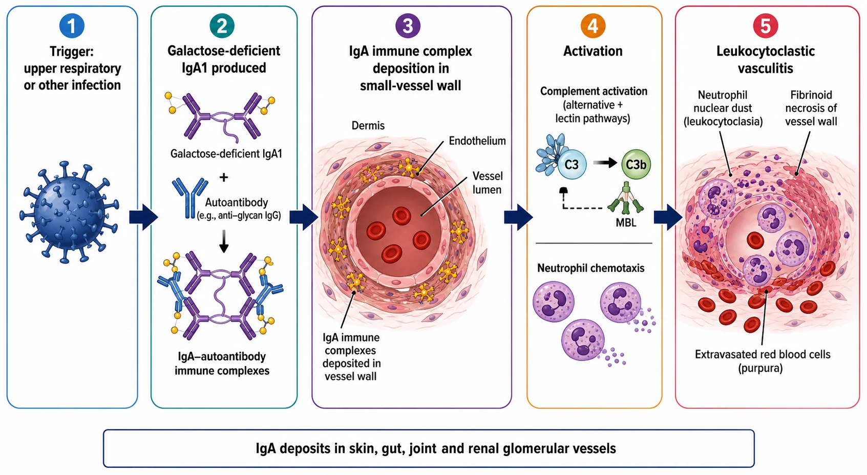 A clean medical-education schematic on a white background showing a left-to-right pipeline of the pathogenesis of IgA vasculitis. Stage 1 shows a trigger box with a virus icon labelled upper respiratory infection. Stage 2 shows an antibody labelled galactose-deficient IgA1 with autoantibodies forming immune complexes. Stage 3 is a vessel cross-section showing the IgA immune complexes depositing in the small-vessel wall. Stage 4 shows complement activation and neutrophil chemotaxis. Stage 5 shows the damaged vessel with leukocytoclastic vasculitis, nuclear dust, fibrinoid necrosis, and extravasated red blood cells producing the palpable purpura.