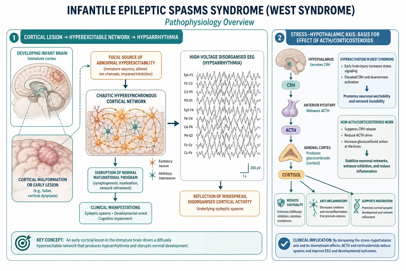 Two-panel pathophysiology schematic: left panel shows an immature developing brain with a focal cortical malformation or early lesion (such as a tuber or area of cortical dysplasia) generating a focal source of abnormal hyperexcitability that recruits a chaotic hypersynchronous cortical network and disrupts normal synaptogenesis and myelination, producing a high-voltage disorganised hypsarrhythmic EEG trace alongside the clinical spasms and developmental arrest; right panel shows the stress hypothalamic axis with the hypothalamus secreting corticotropin-releasing hormone CRH that drives the anterior pituitary to release ACTH and the adrenal cortex to produce cortisol, with the explanation that early brain injury raises CRH signalling which is proconvulsant in the immature brain, and that ACTH and corticosteroids work by dampening this CRH drive and stabilising the network