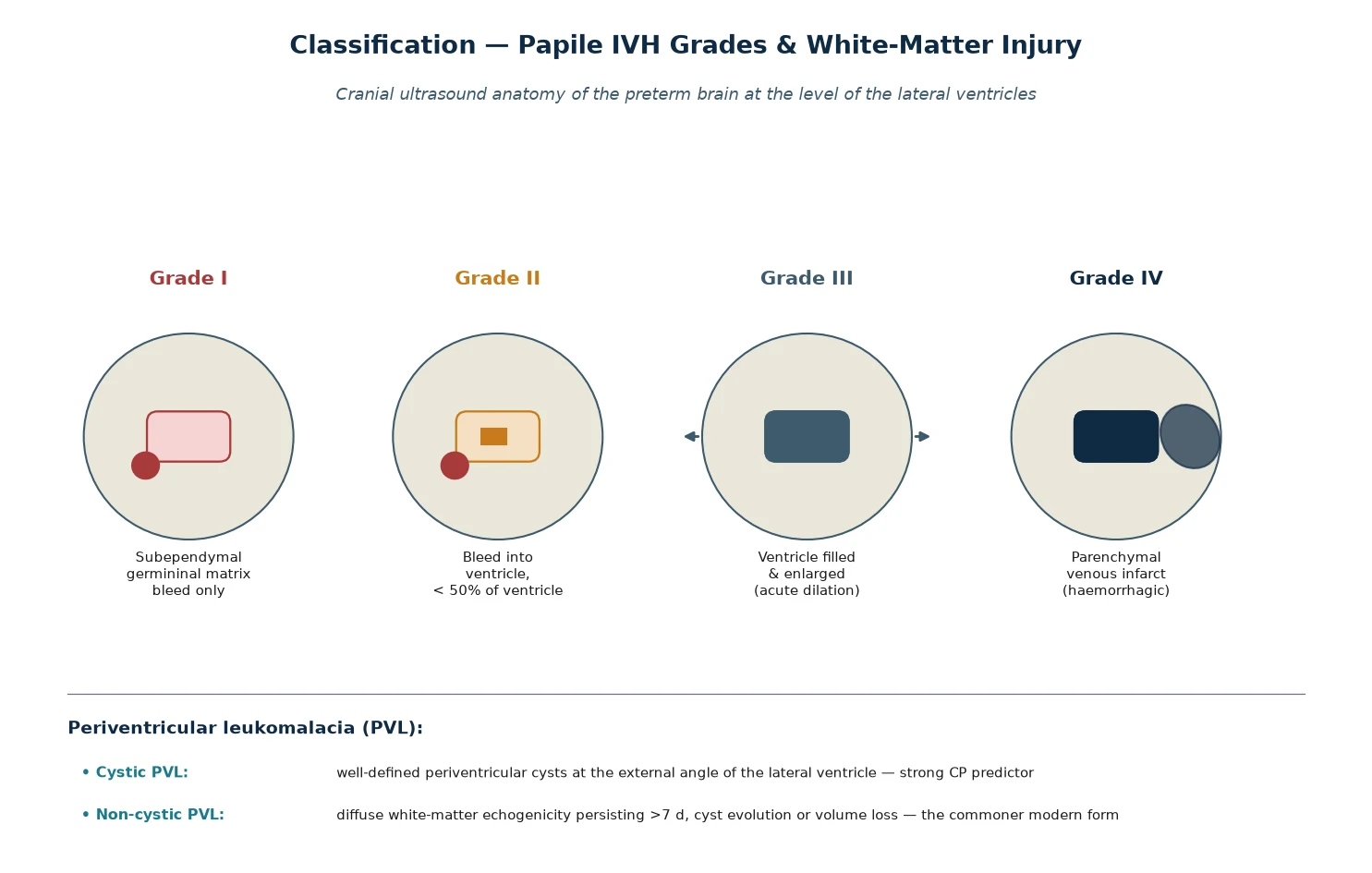 Papile grading of intraventricular haemorrhage grades I to IV on cranial ultrasound cross-sections, alongside cystic versus non-cystic periventricular leukomalacia