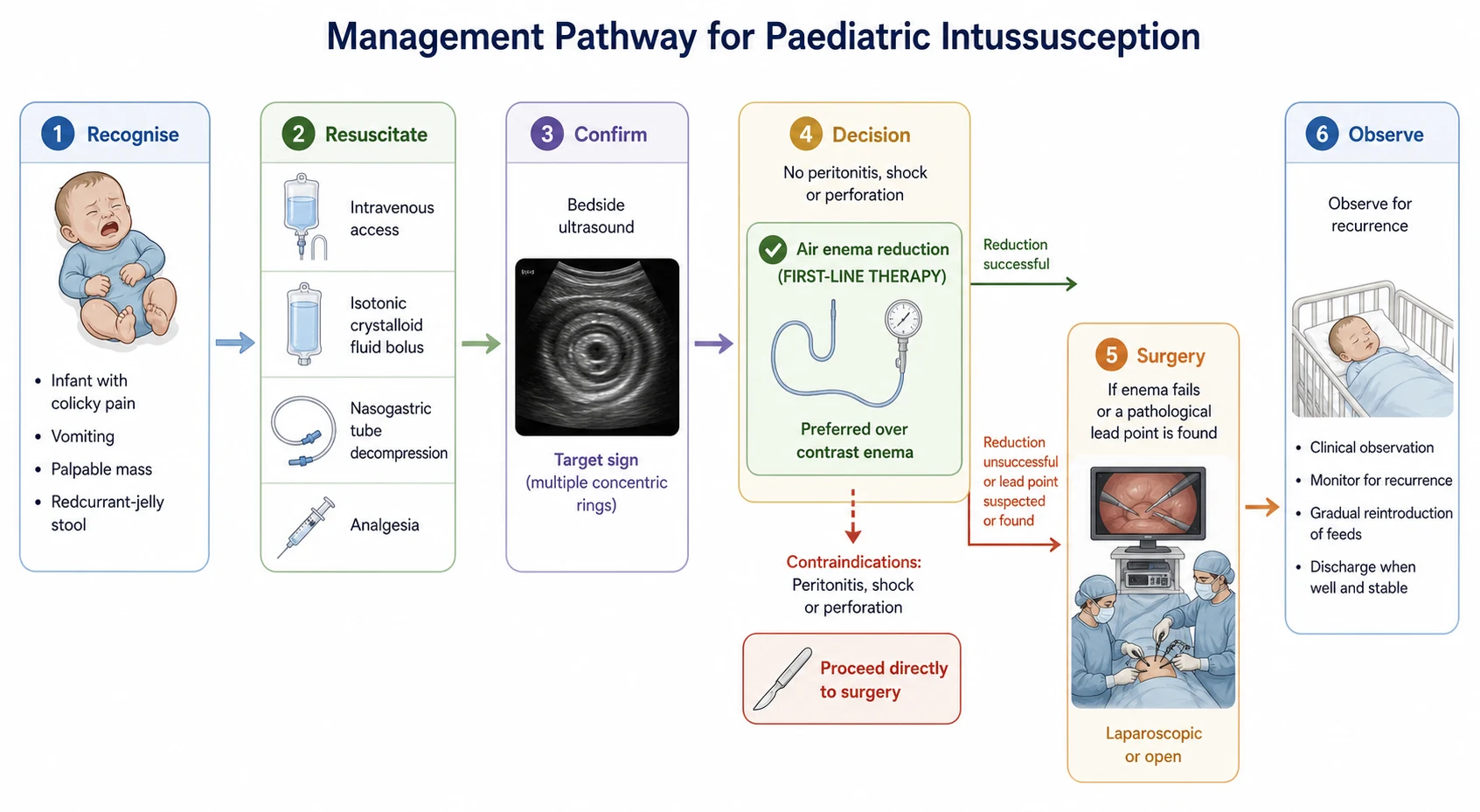 Six-step management pathway flowchart. Step one recognise an infant with colicky pain, vomiting, a palpable mass and redcurrant-jelly stool. Step two resuscitate with intravenous access, an isotonic crystalloid fluid bolus, a nasogastric tube and analgesia. Step three confirm with bedside ultrasound showing the target sign. Step four a decision branch with air enema reduction as first-line preferred over contrast enema, and a contraindication arrow straight to surgery for peritonitis, shock or perforation. Step five surgery, laparoscopic or open, if enema fails or a pathological lead point is found. Step six observe for recurrence.