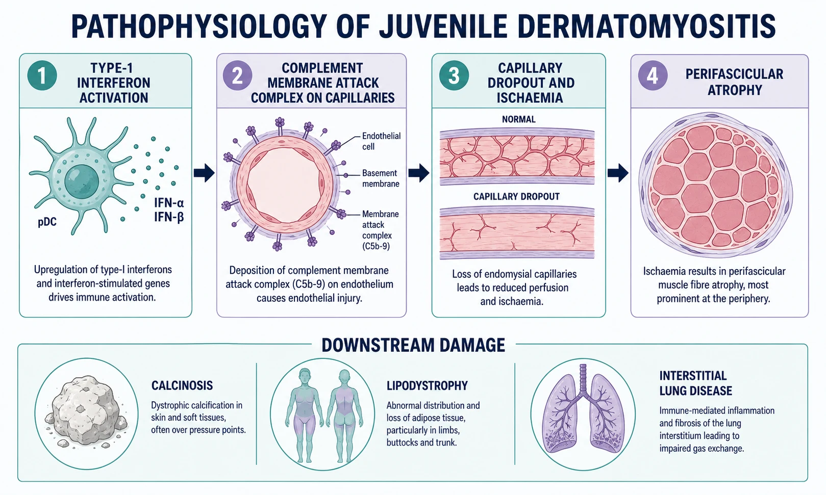 Educational mechanism schematic of juvenile dermatomyositis showing the type-one interferon-driven immune response, complement membrane attack complex deposition on capillaries, capillary dropout and perifascicular ischaemia, perifascicular atrophy on muscle biopsy, and the downstream calcinosis, lipodystrophy and interstitial lung disease
