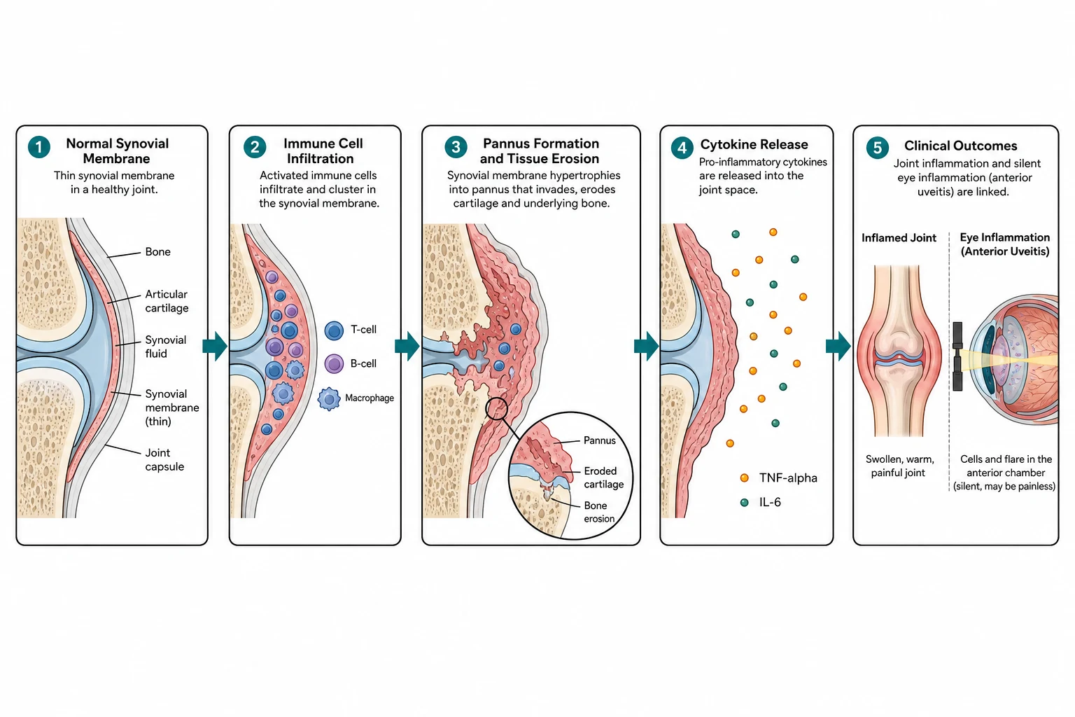 A clean scientific schematic on a white background flowing left to right in five connected boxes joined by teal arrows. The first box shows a joint capsule with a thin normal synovium. The second box shows the activated immune cells, T cells and B cells and macrophages, infiltrating the synovium. The third box shows the hypertrophied pannus invading the cartilage and bone with a magnified synovial membrane. The fourth box shows cytokine molecules labelled tumour necrosis factor alpha and interleukin being released into the joint. The fifth box shows a swollen joint and a separate eye with anterior chamber cells and a slit-lamp beam, linking the joint and the silent uveitis.