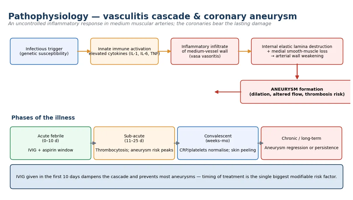 Educational mechanism schematic of Kawasaki disease showing the inflammatory cascade from infectious trigger through innate immune activation, inflammatory infiltrate of the medium-vessel wall, destruction of the internal elastic lamina, aneurysm formation with altered flow and thrombosis risk, alongside the three phases of illness from acute febrile through sub-acute to convalescent and chronic