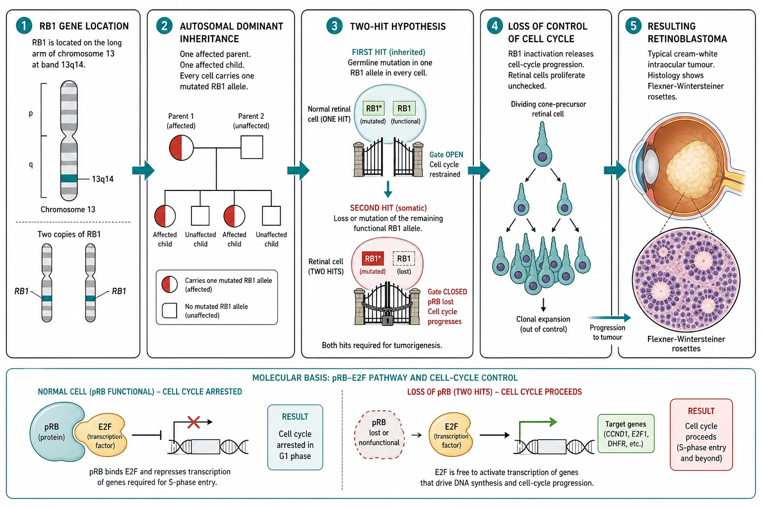 A clean scientific schematic on a white background in landscape flowing left to right in five connected boxes joined by teal arrows. The first box shows the chromosome with the RB1 gene highlighted on chromosome thirteen long arm at band thirteen-q-fourteen, with two copies. The second box shows a family pedigree with autosomal dominant inheritance, one affected parent and one affected child, every cell carrying one mutated RB1 allele as the half-filled symbols. The third box shows the two-hit diagram, with a normal retinal cell with both RB1 copies functional and the cell-cycle gate open, then a second somatic hit removing the remaining functional copy and the gate closing, releasing the cell-cycle progression. The fourth box shows a dividing cone-precursor retinal cell cycling out of control, with an arrow into a tumour mass. The fifth box shows the resulting retinoblastoma as a cream-white tumour mass with the Flexner-Wintersteiner rosettes drawn as small ring-of-cells structures under a microscope-circle icon. Below the boxes a horizontal molecular bar shows the pRB protein binding the E2F transcription factor in a normal cell with the cell cycle arrested, and the loss of the pRB freeing the E2F with the cell cycle proceeding
