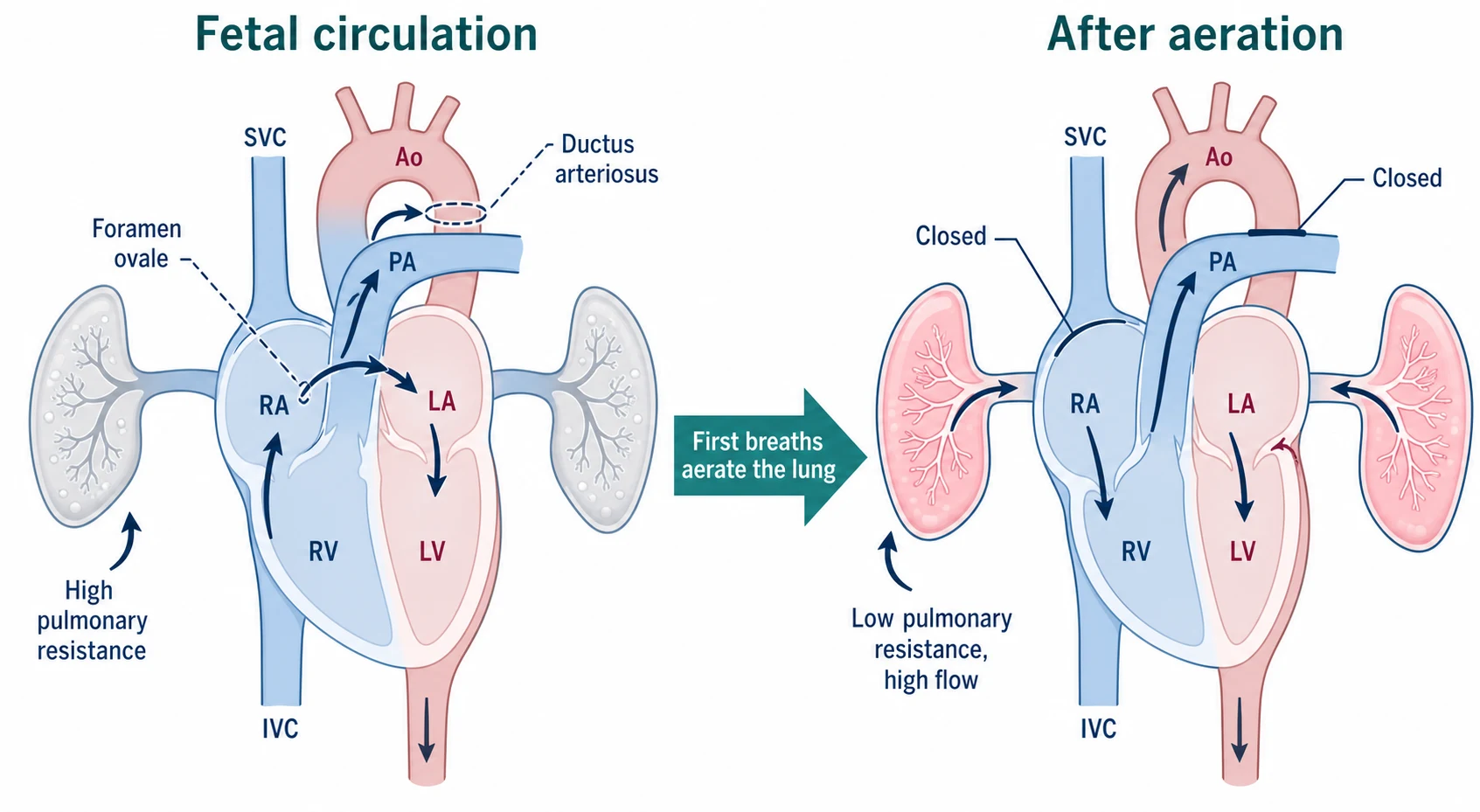 Educational before-and-after circulatory schematic contrasting open fetal shunts with high pulmonary resistance against closed shunts with low-resistance aerated lungs after aeration