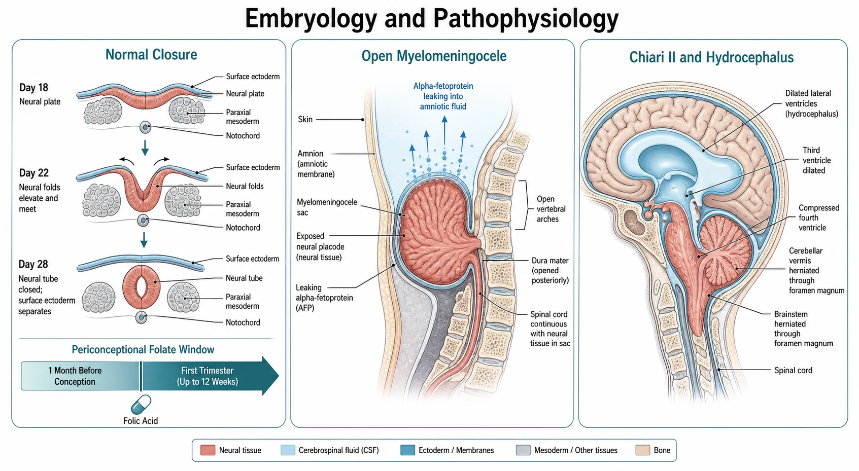 A clean medical schematic on a white background titled Embryology and Pathophysiology of Neural Tube Defects. The left panel shows the normal neural tube closure across days 18 to 28, with the neural plate folding into a tube and the anterior neuropore closing at day 24 and the posterior neuropore at day 28, beside a timeline showing the periconceptional folate window of one month before conception through the first trimester. The centre panel shows the open myelomeningocele as a cross section with the neural placode exposed on the back, the open vertebral arches, and the cystic sac of meninges and neural tissue, with alpha-fetoprotein leaking across into the amniotic fluid and the maternal serum. The right panel shows the Chiari II malformation with the cerebellar vermis and the brainstem herniated downward through the foramen magnum, the compressed fourth ventricle, and the obstructive hydrocephalus with the ballooned lateral ventricles.