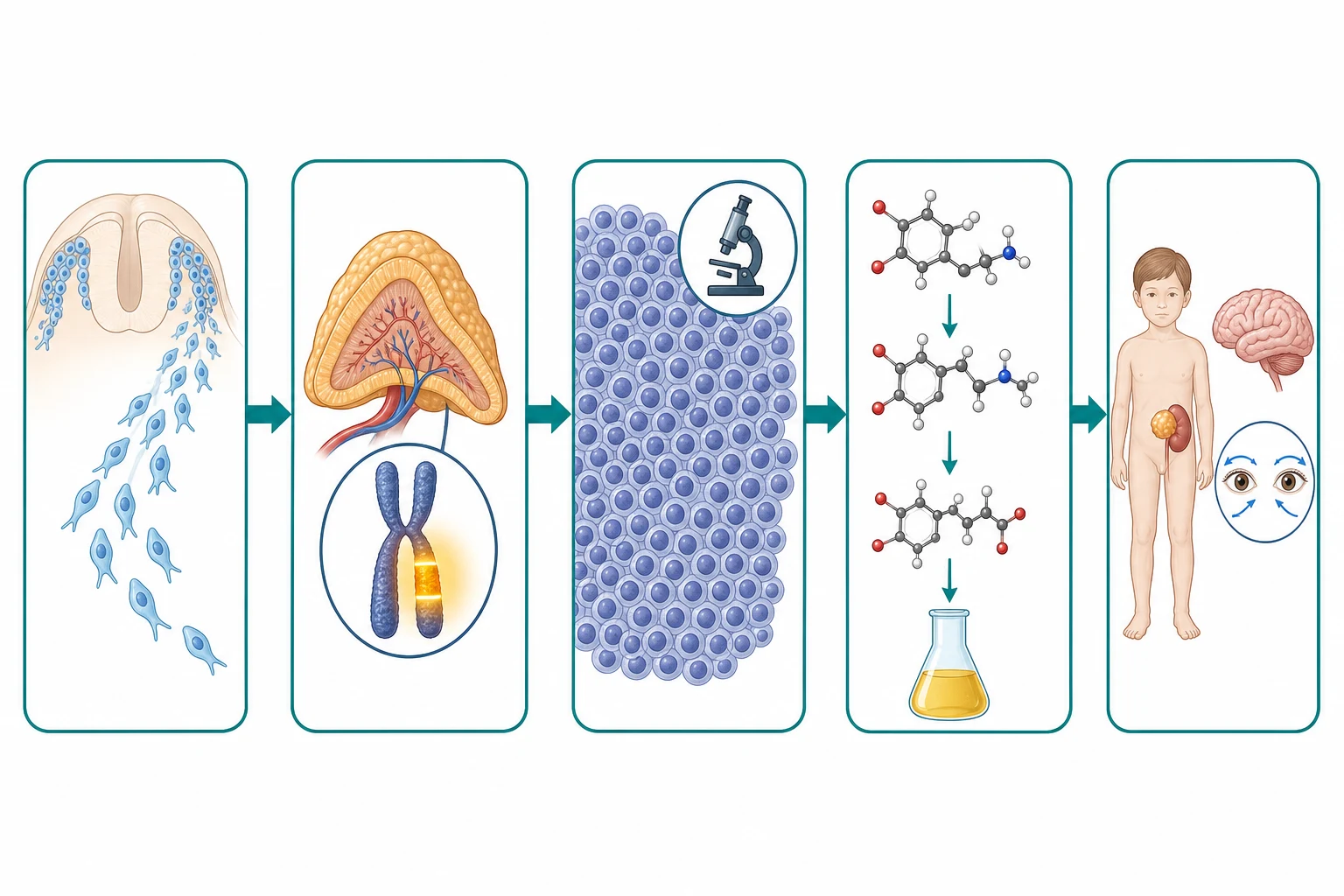 A clean scientific schematic on a white background flowing left to right in five connected boxes joined by teal arrows. The first box shows the neural crest with migrating sympathogonia precursor cells. The second box shows the developing adrenal gland with a chromosome highlighting the MYCN gene amplified. The third box shows sheets of small round blue cells under a microscope-circle icon representing the neuroblastoma histology. The fourth box shows a catecholamine pathway with dopamine and norepinephrine molecules flowing into a urine flask. The fifth box shows a child with an adrenal mass and a separate brain icon with dancing-eye arrows representing opsoclonus.